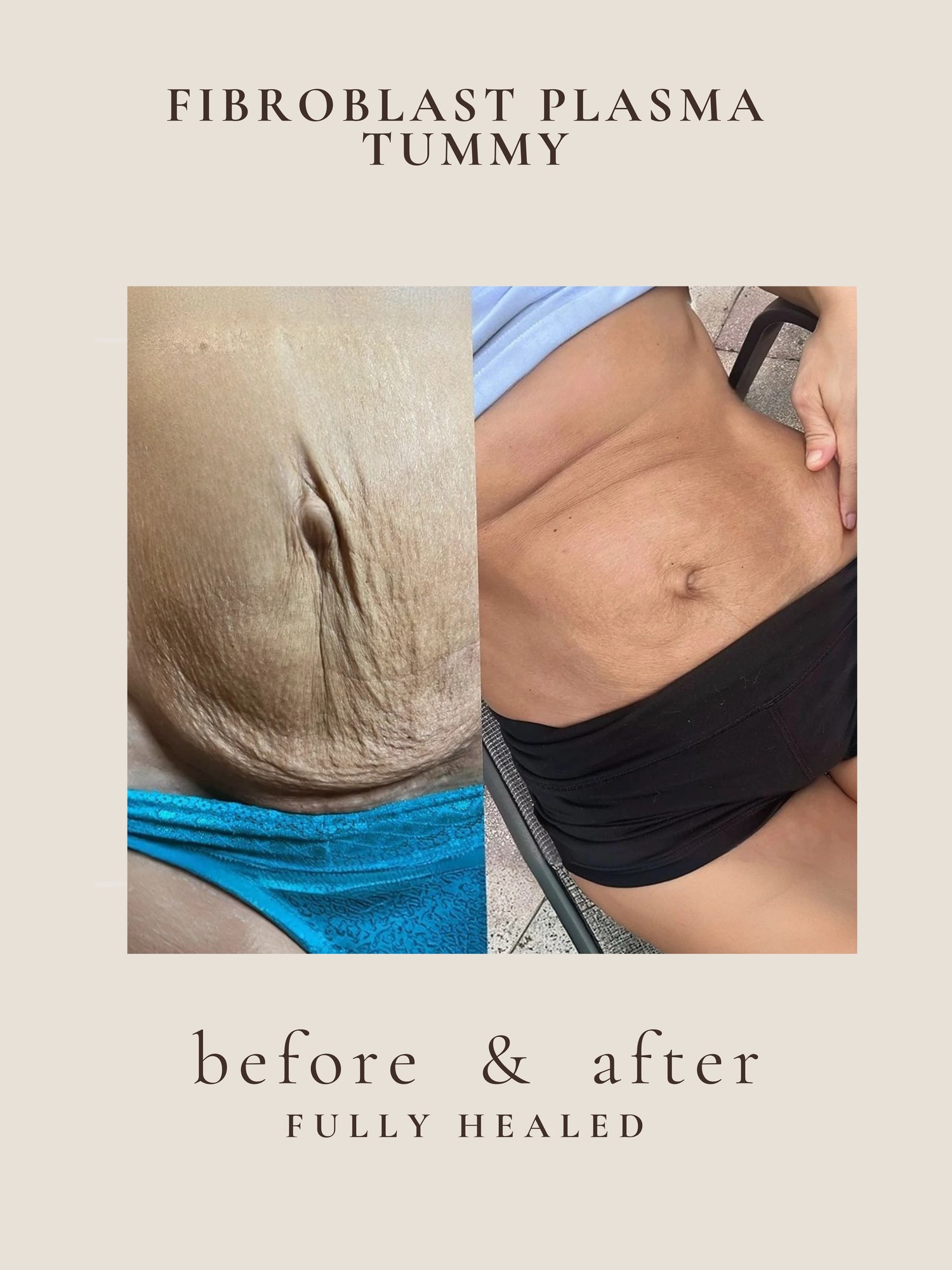 Non-surgical mommy makeover before and after — abdomen tightening with plasma