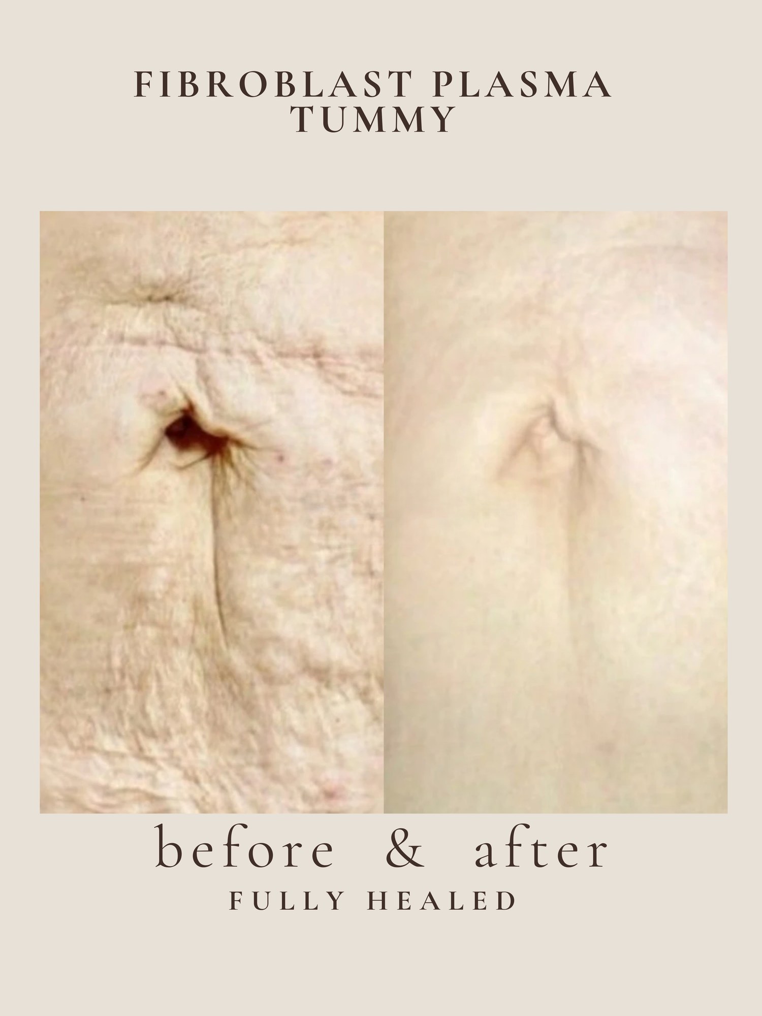Before and after abdomen tightening