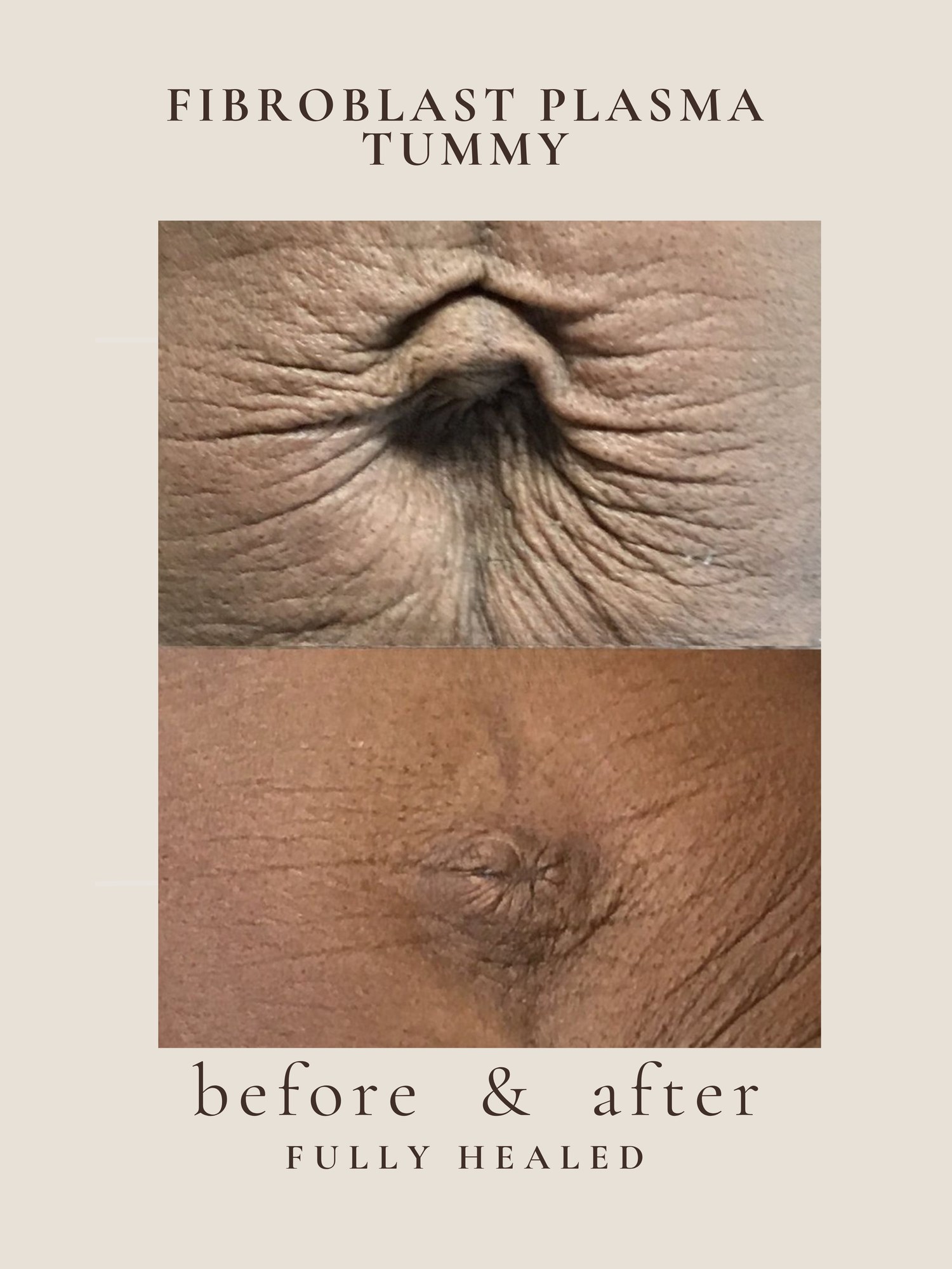 Before and after non-surgical abdomen tightening with Fusion Plasma at Awakened Skin