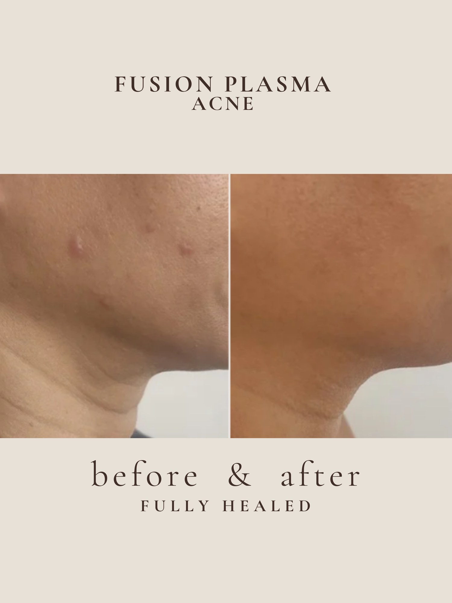 Active acne treatment with plasma — before and after