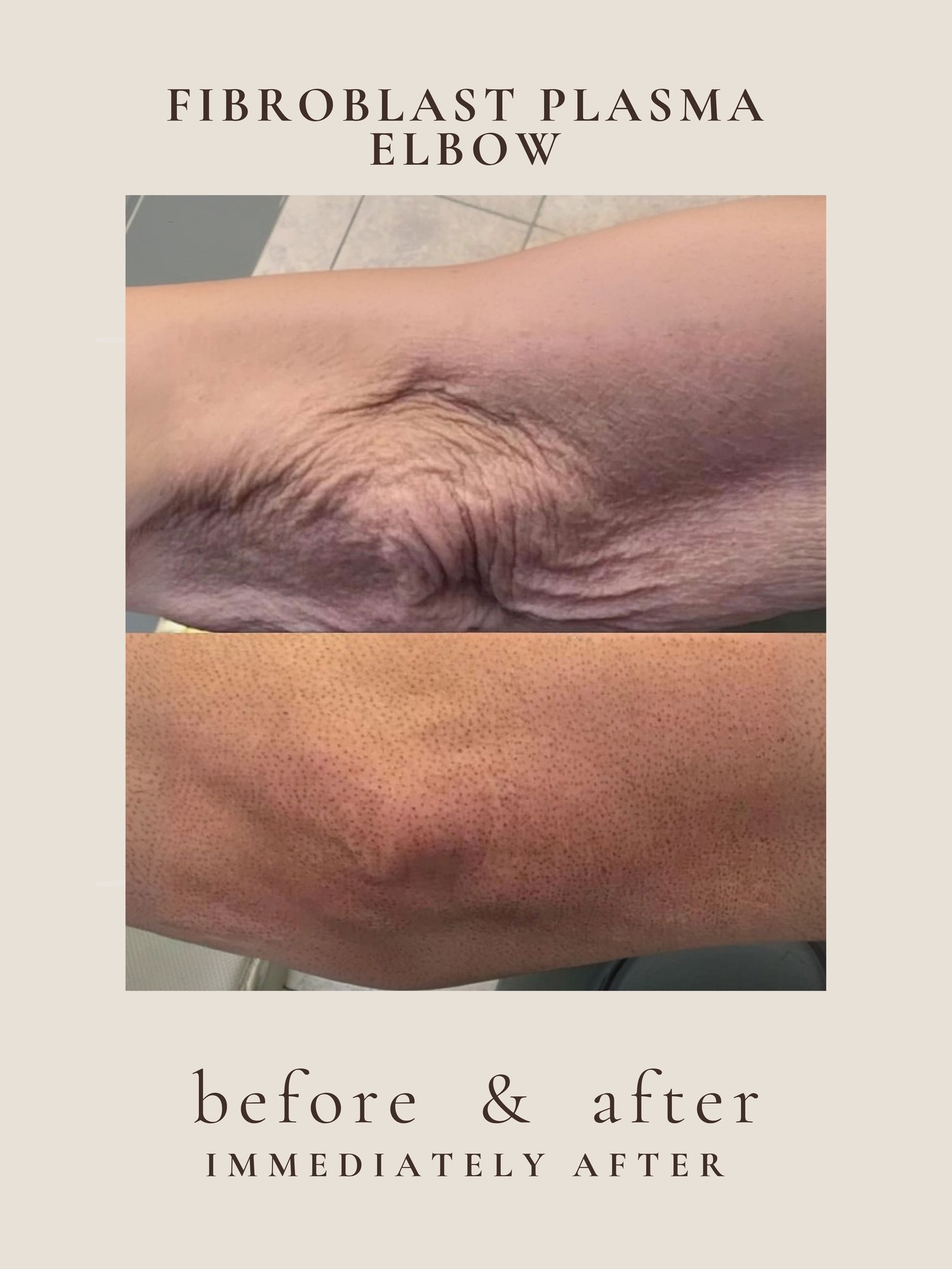 Arm tightening before and after with plasma