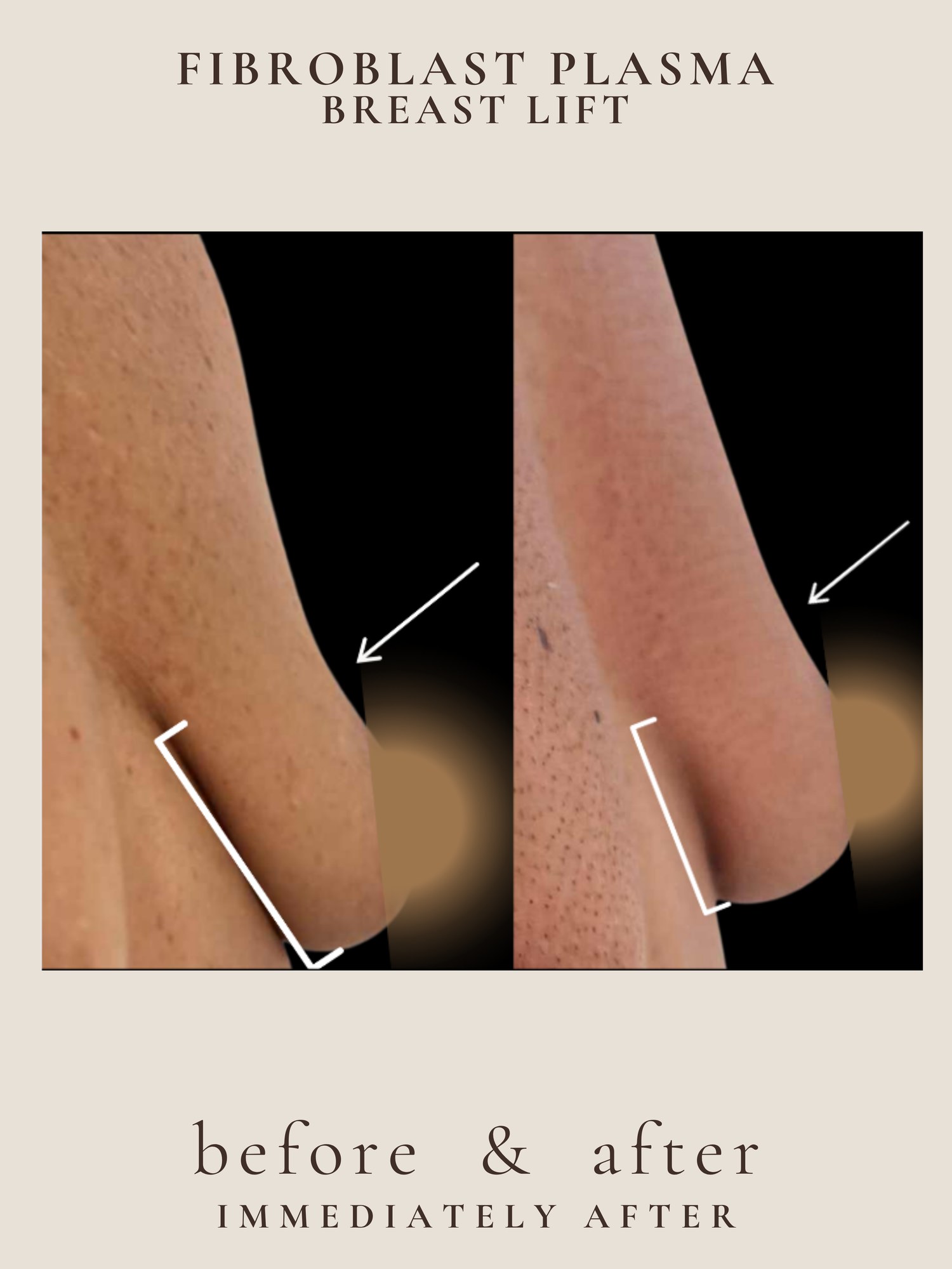 Before and after non-surgical breast lift with plasma