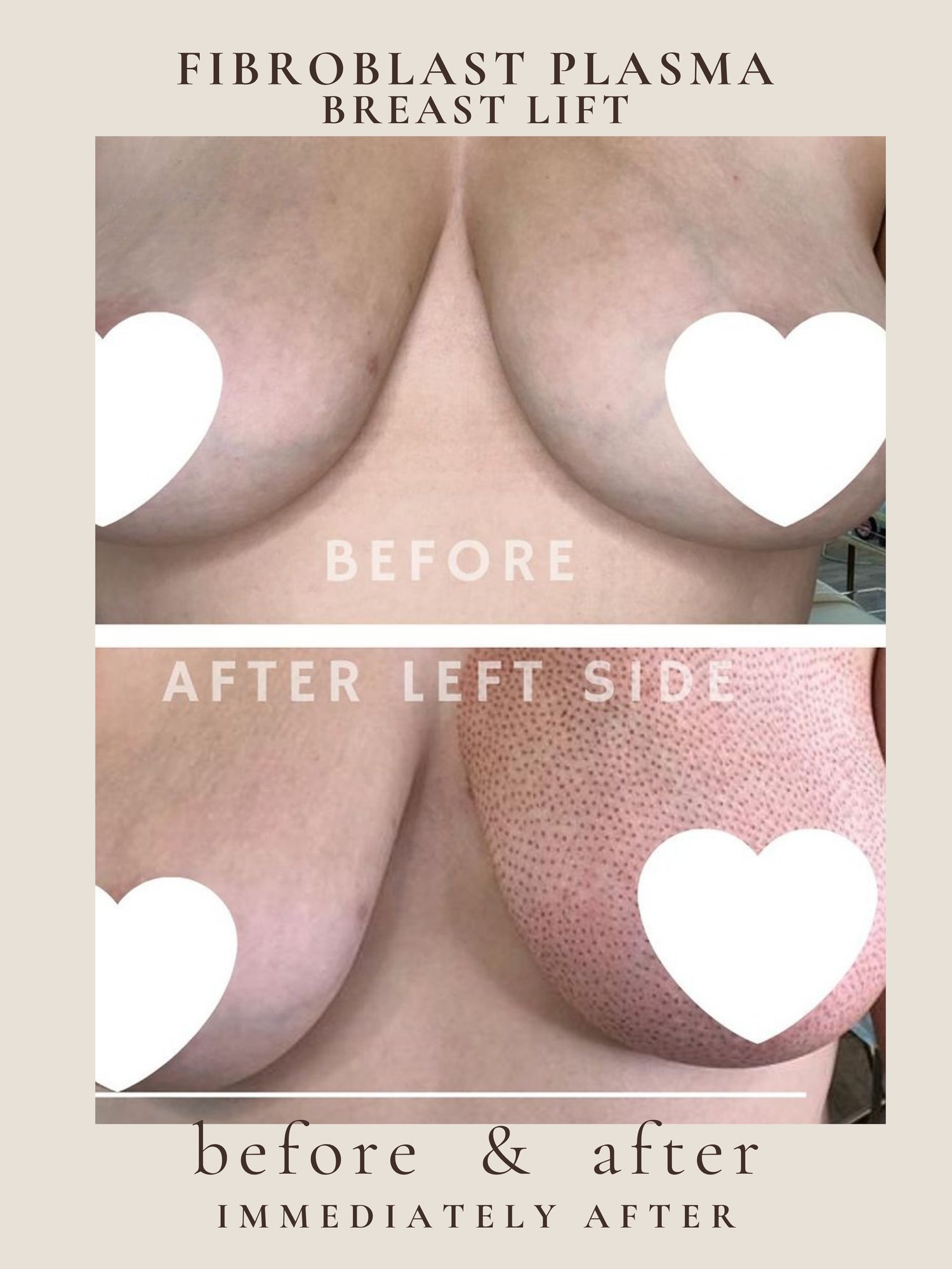 Before and after non-surgical breast lift