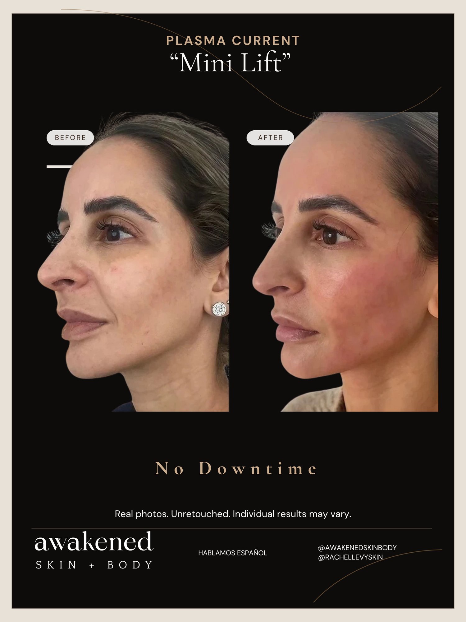 Mini Lift before and after, Plasma Current