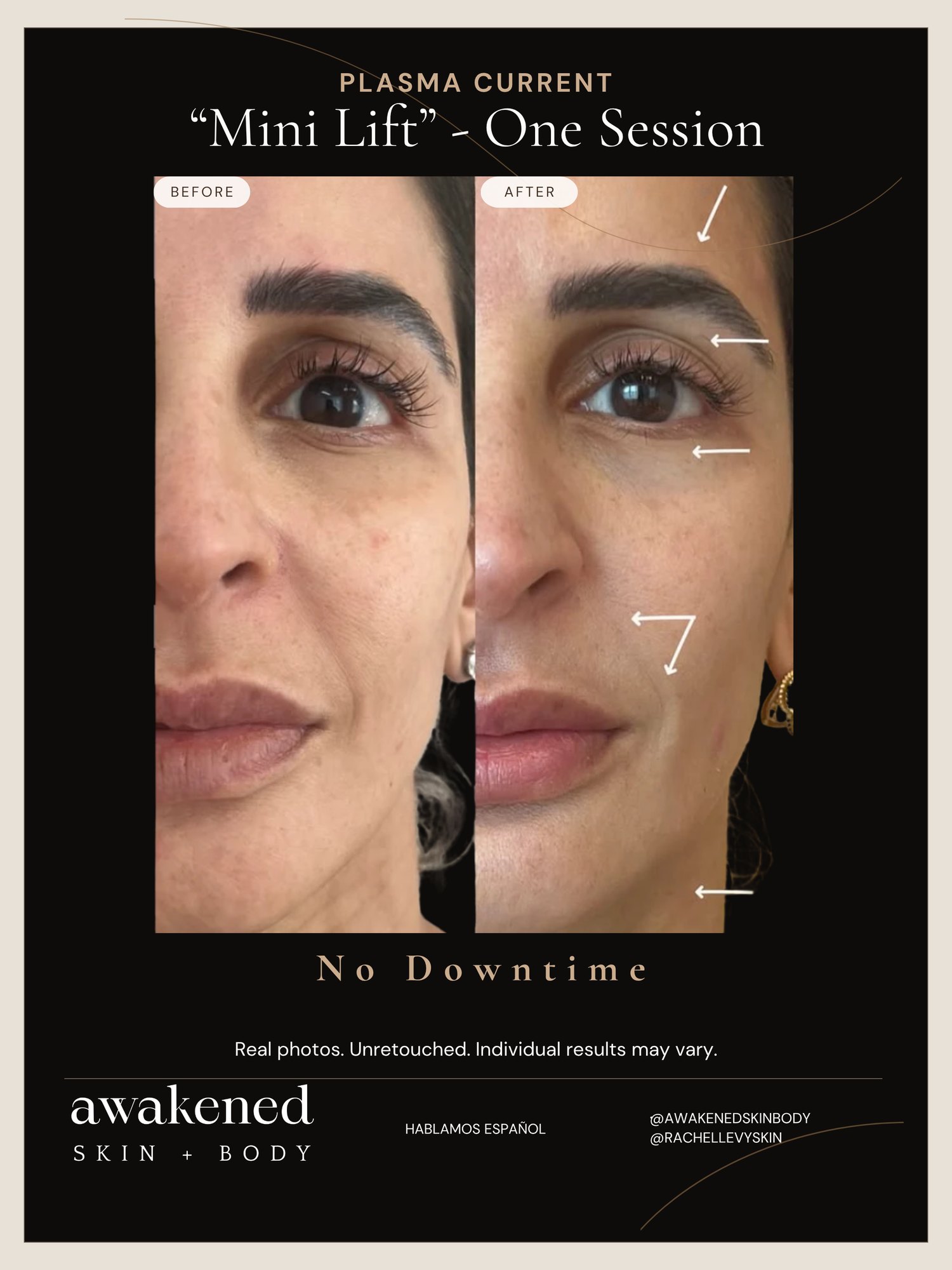 Mini Lift before and after, Plasma Current