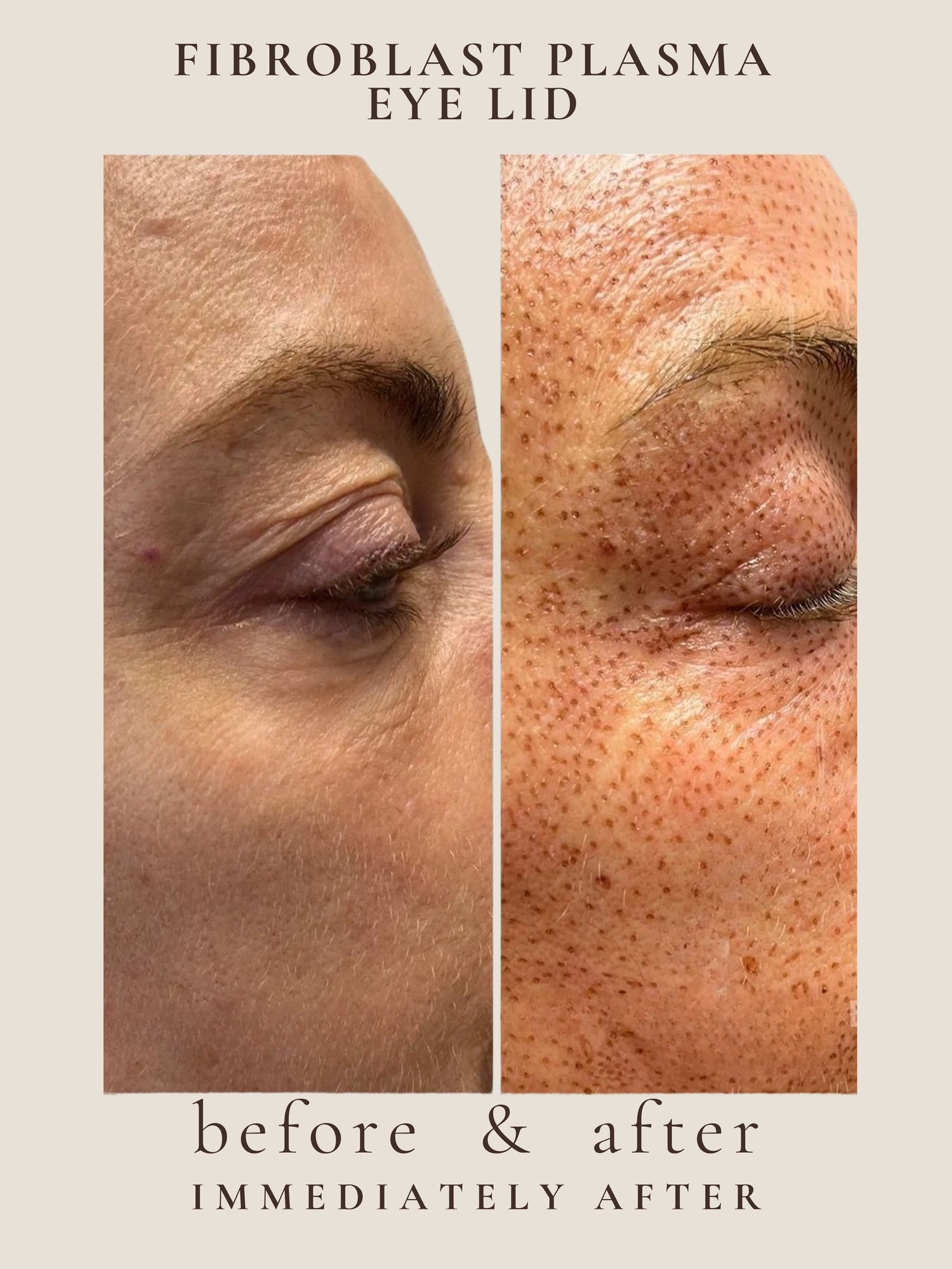 Eye Lift — Fibroblast Plasma · Panda Eye