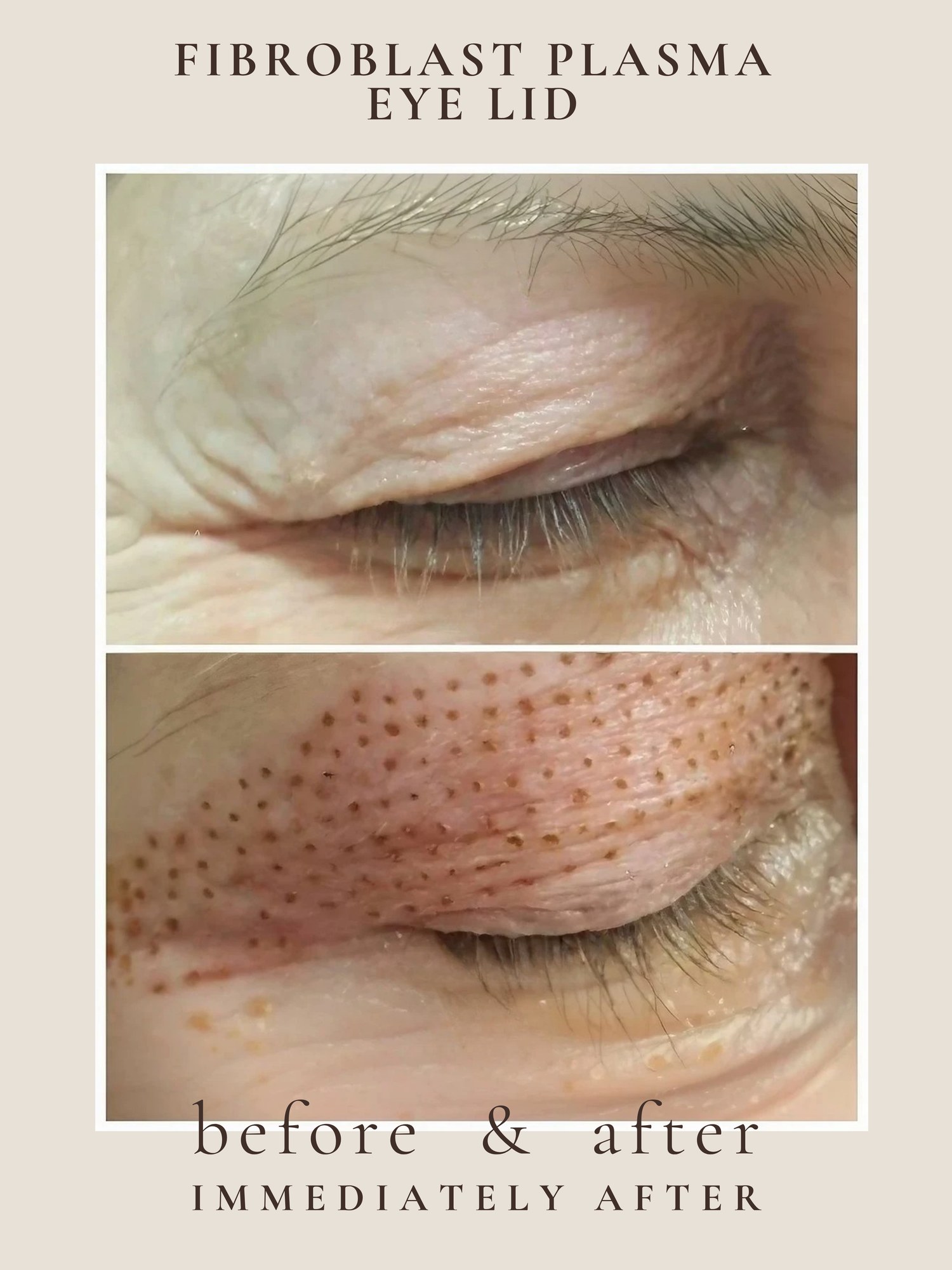 Eye Lift — Fibroblast Plasma · Panda Eye