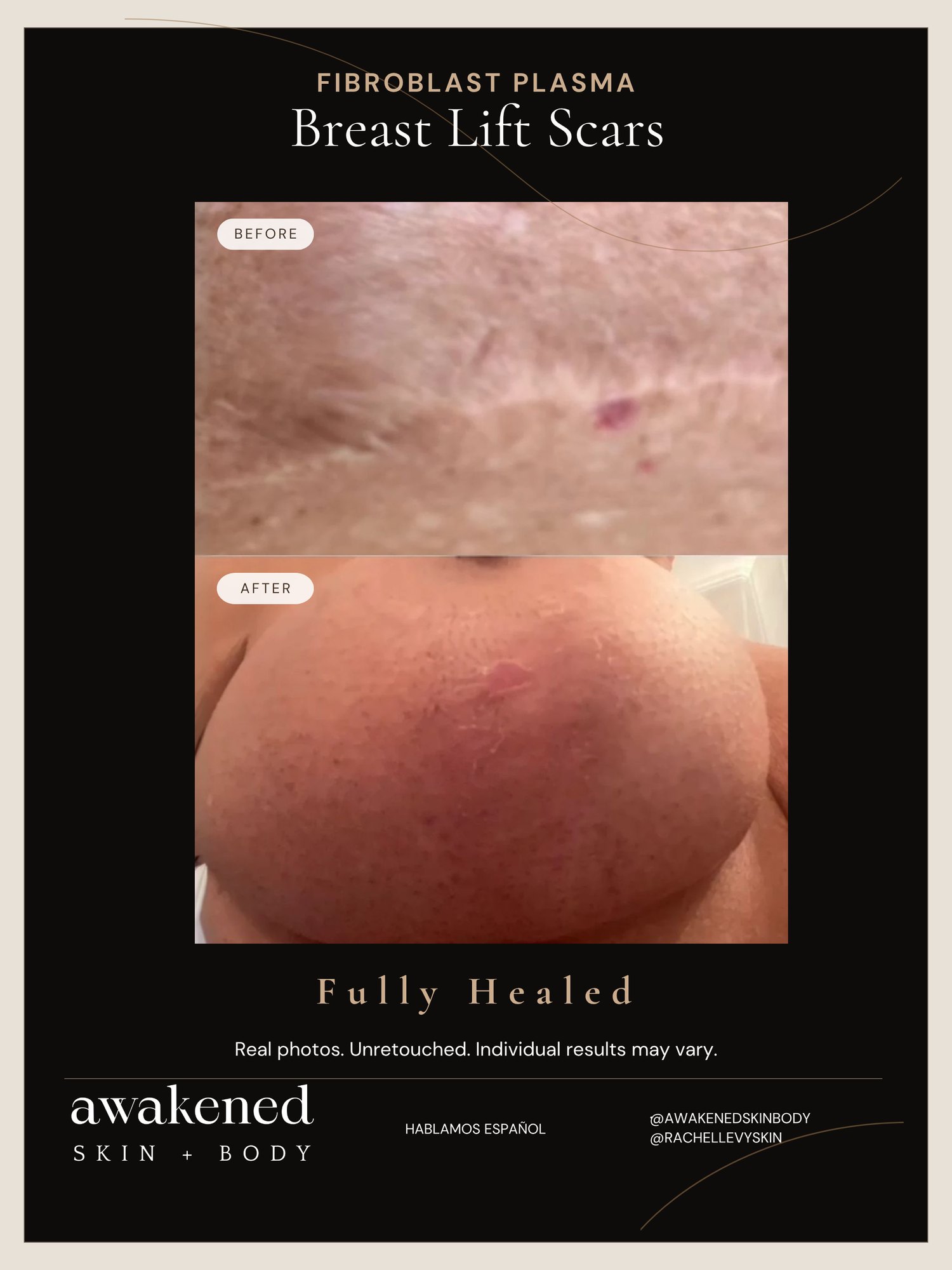 Breast lift before and after, non-surgical