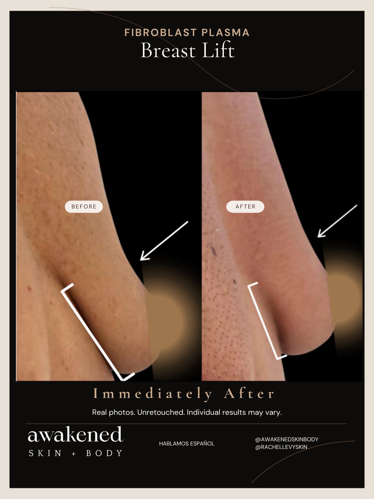 Breast Lift before and after, Fibroblast Plasma