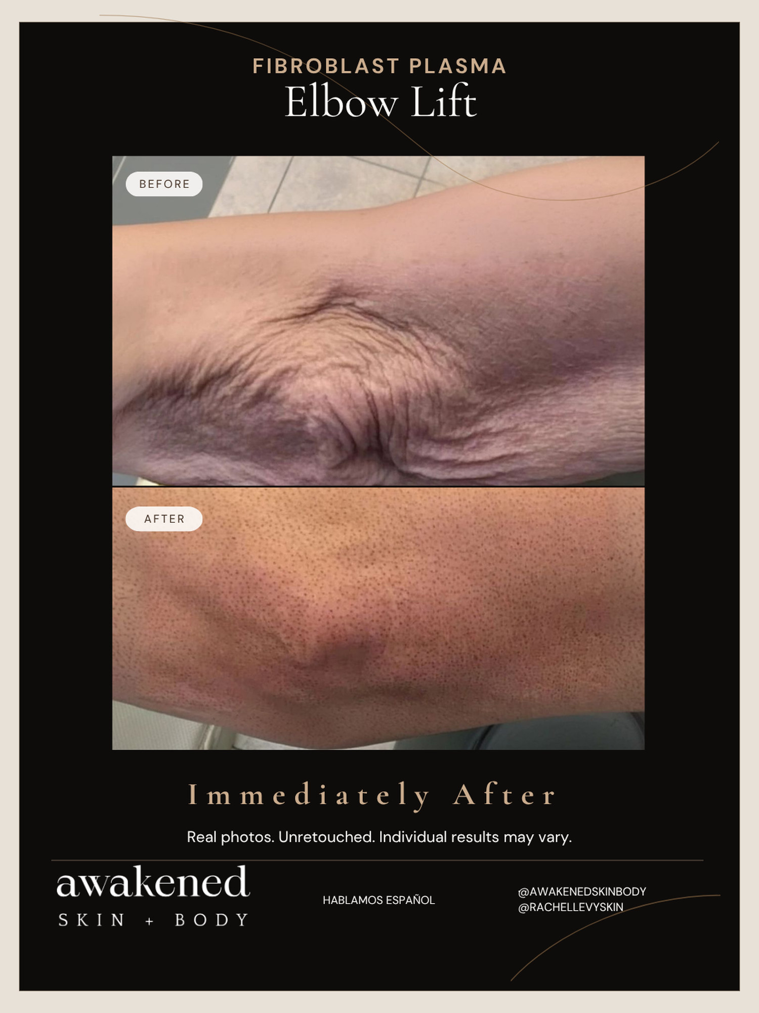 Elbow before and after, Fibroblast Plasma