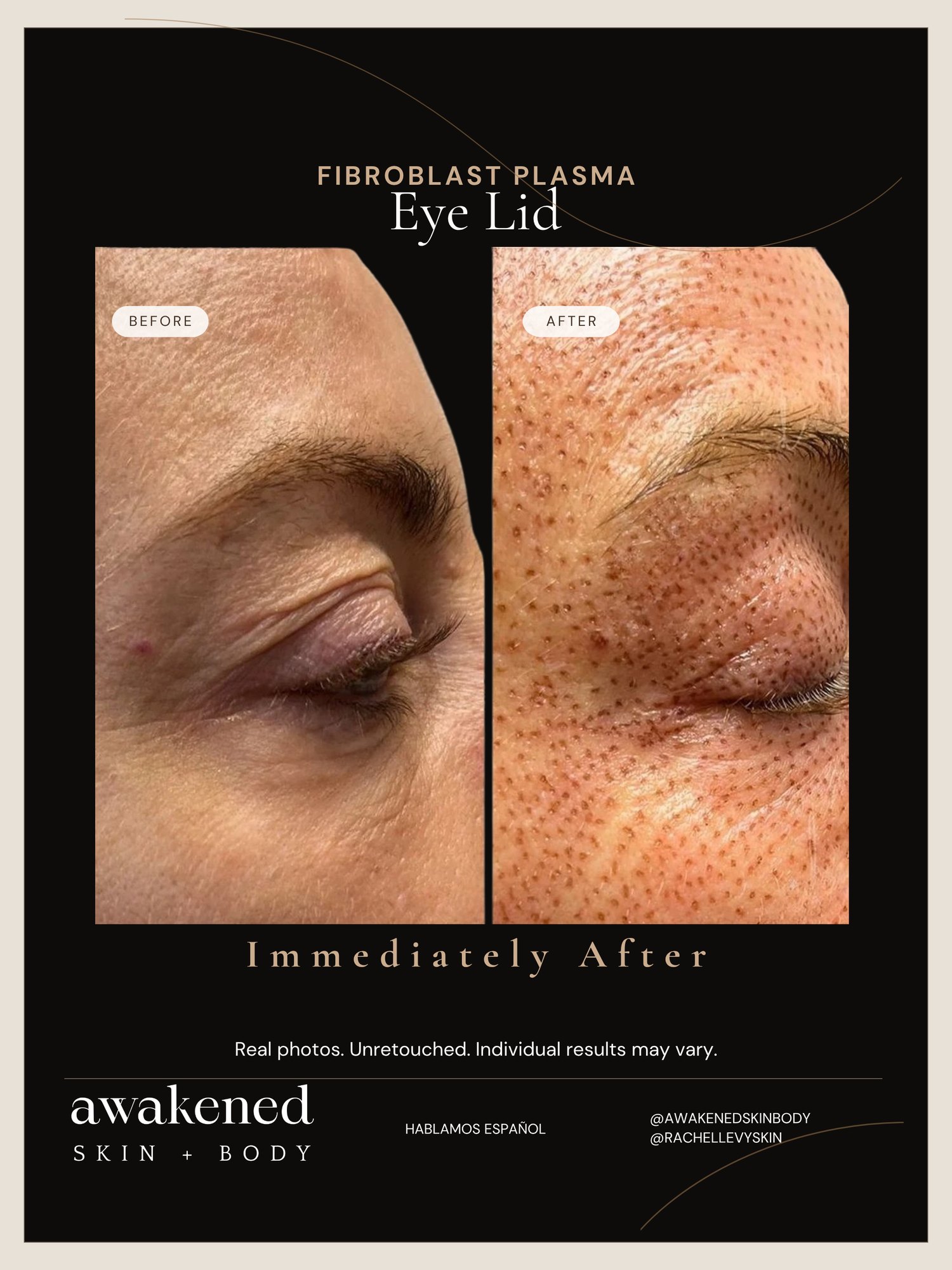 Fibroblast plasma eyelid lift before and after