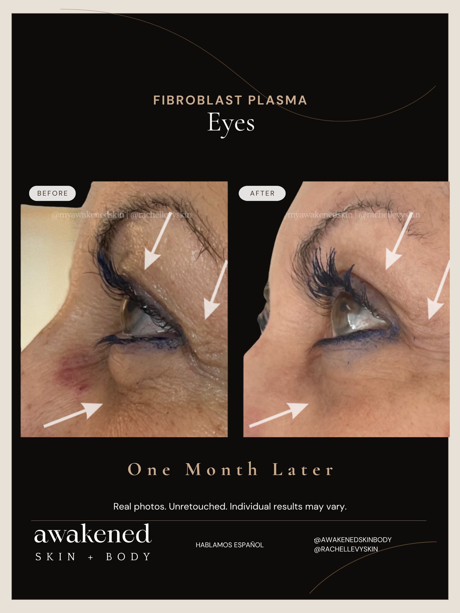 Fibroblast eyelid tightening before and after, real client
