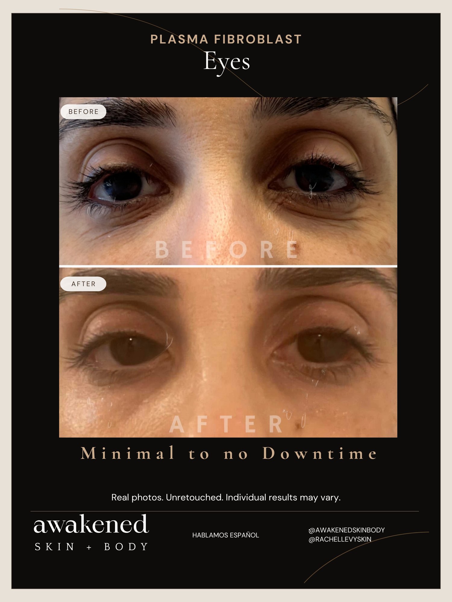 Fibroblast under-eye and eyelid before and after, South Florida client