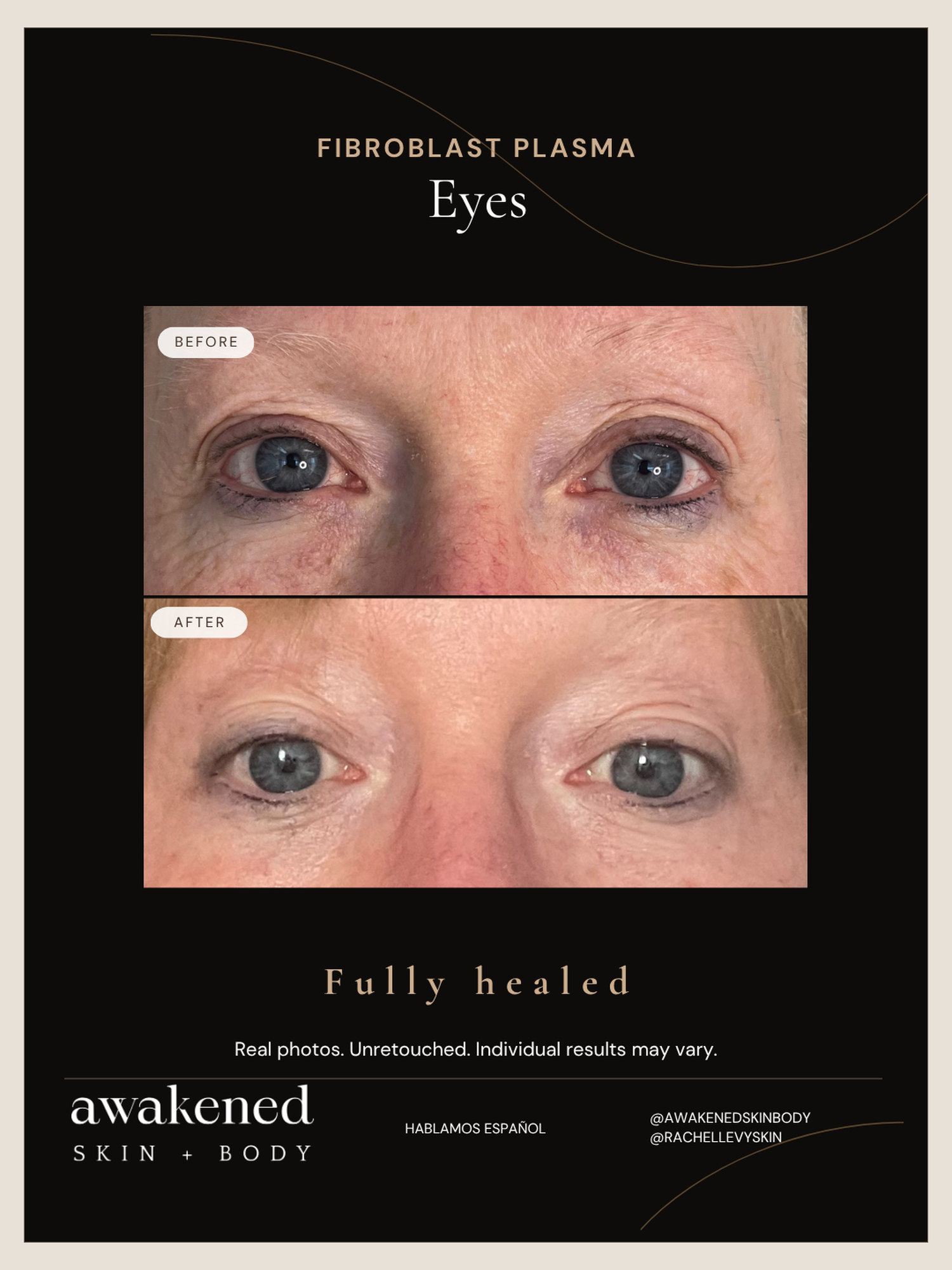 Eyes before and after, Fibroblast Plasma