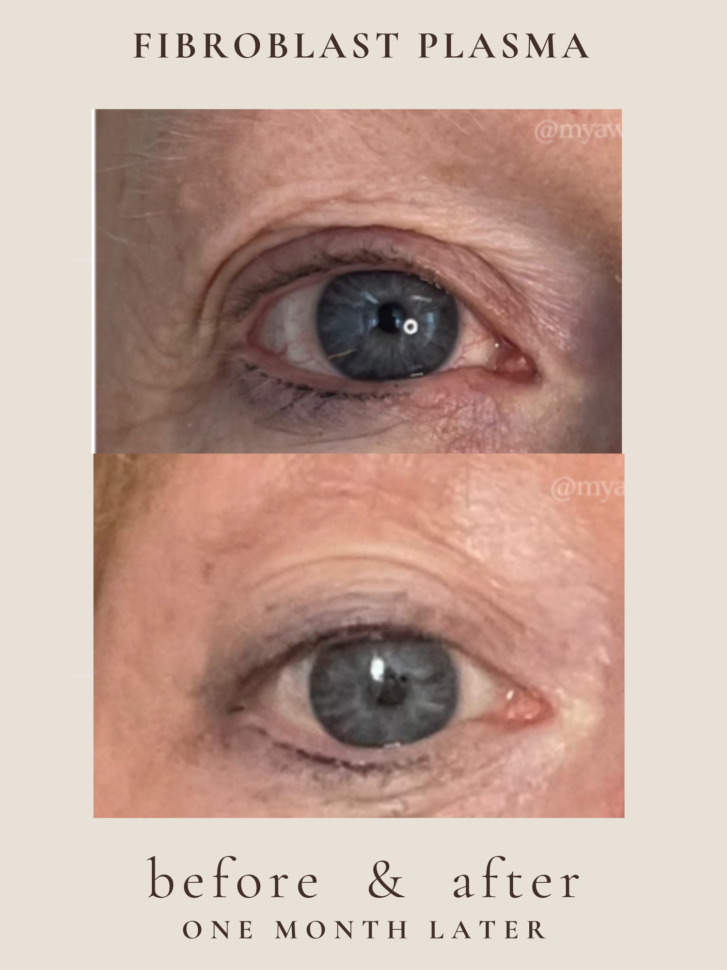Full Face — Fibroblast Plasma
