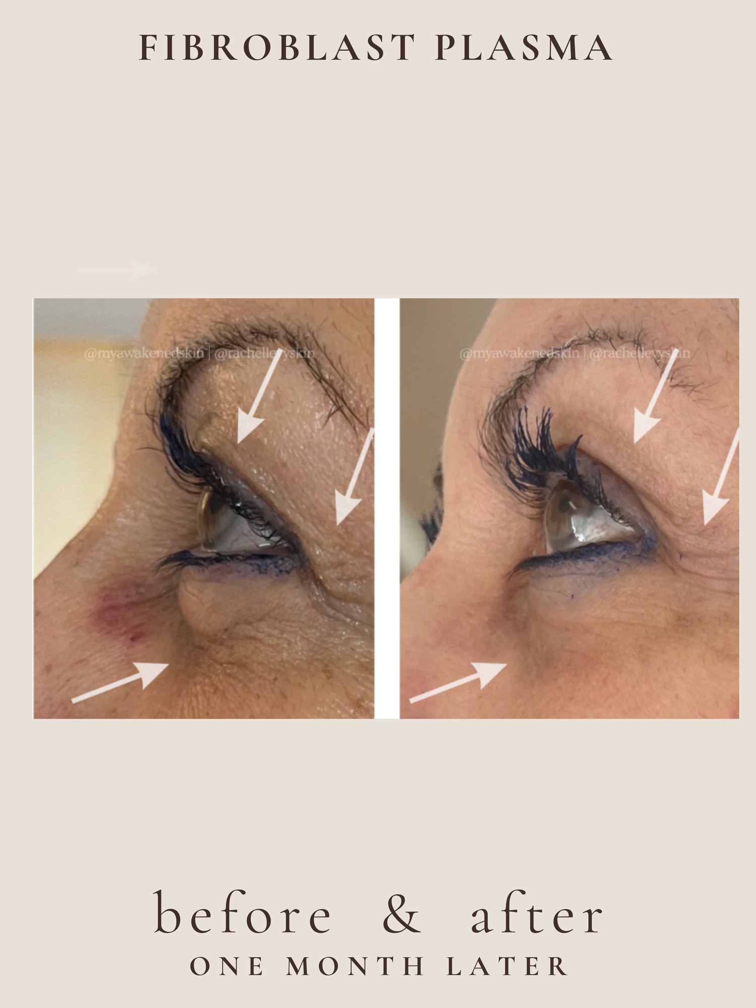 Full Face — Fibroblast Plasma