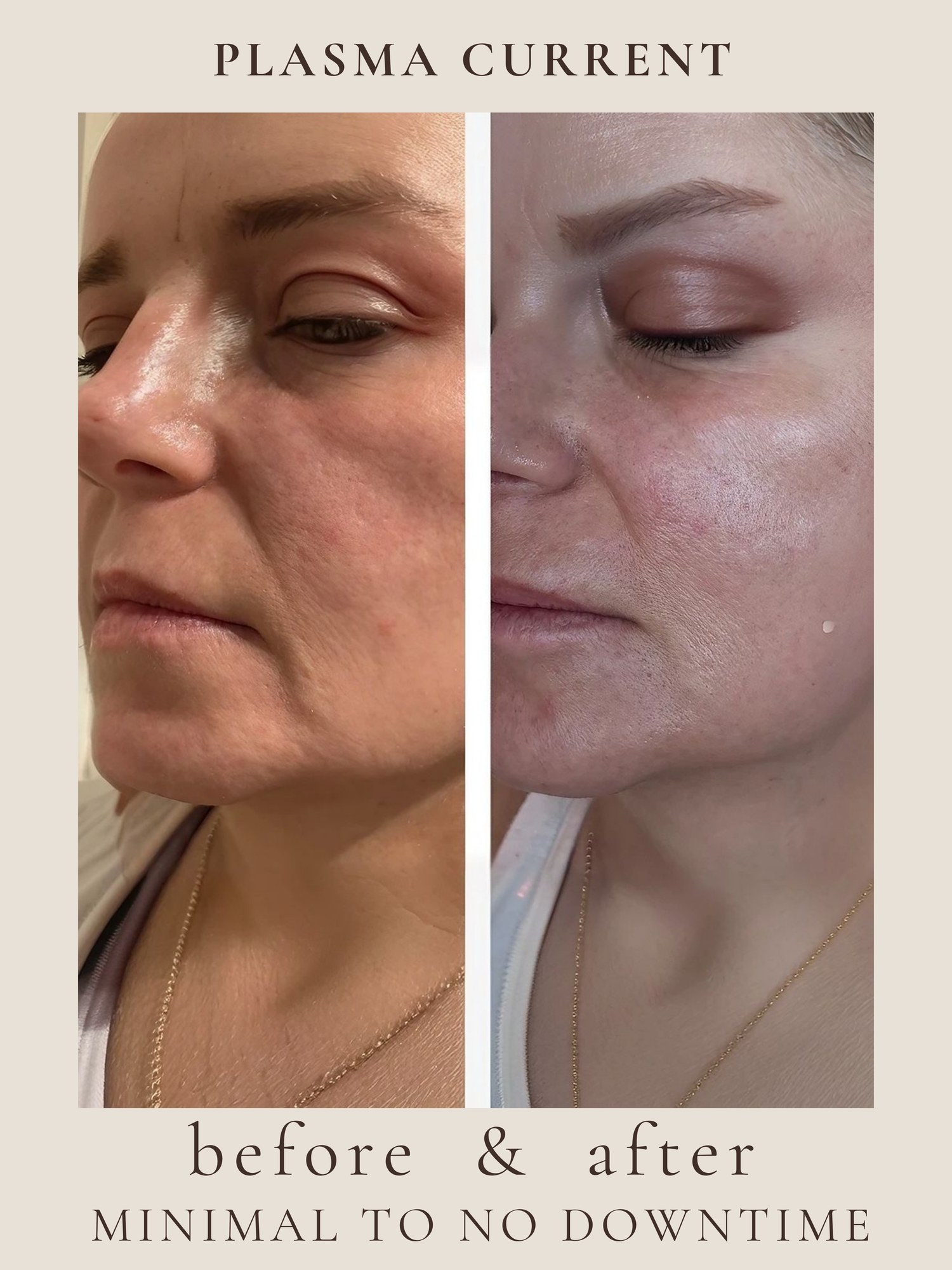 Full Face — Fibroblast Plasma