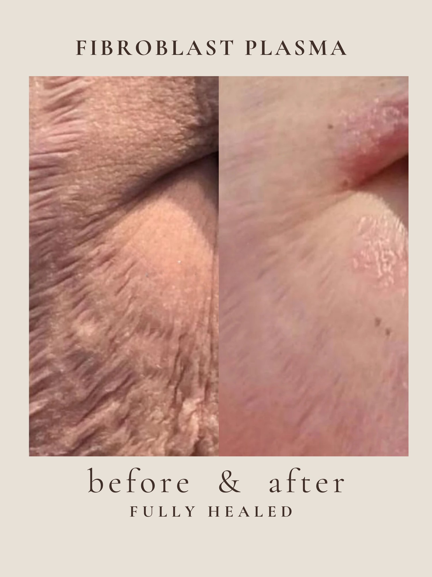 Full Face — Fibroblast Plasma