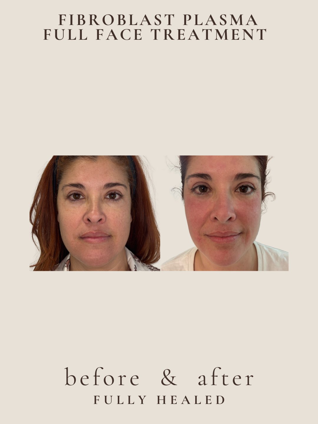 Full face Fibroblast before and after, fully healed