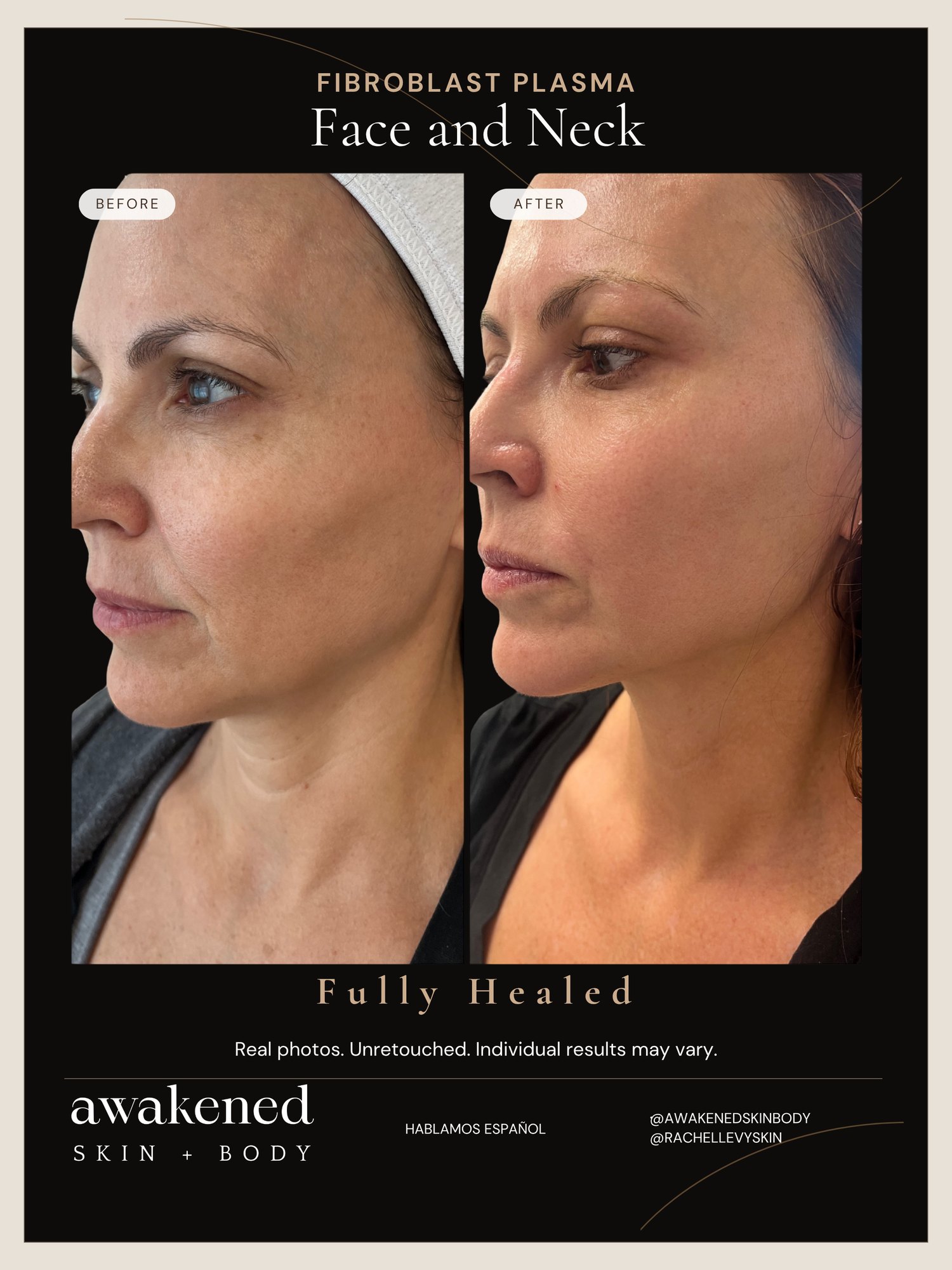 Fibroblast face and neck before and after, real client