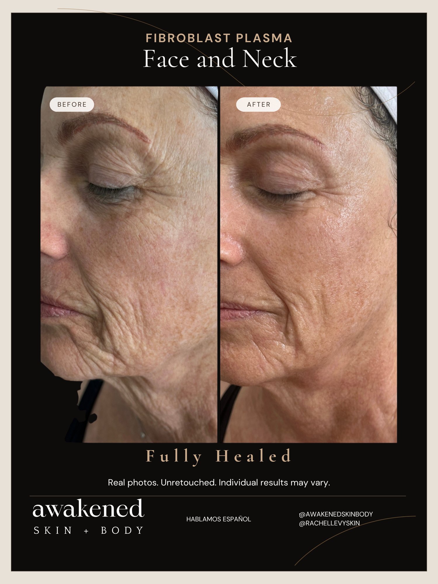 Face & Neck before and after, Fibroblast Plasma