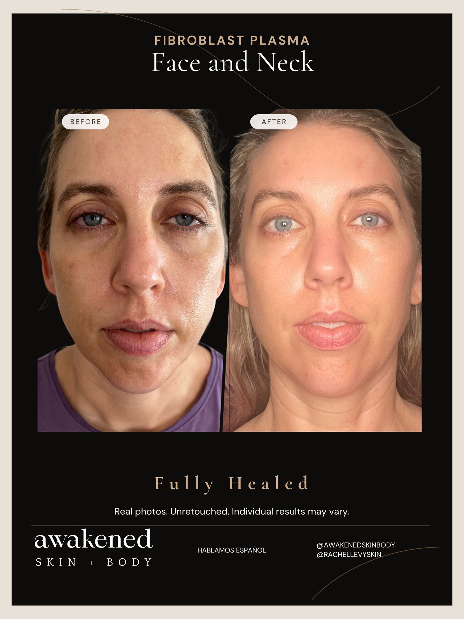 Face & Neck before and after, Fibroblast Plasma
