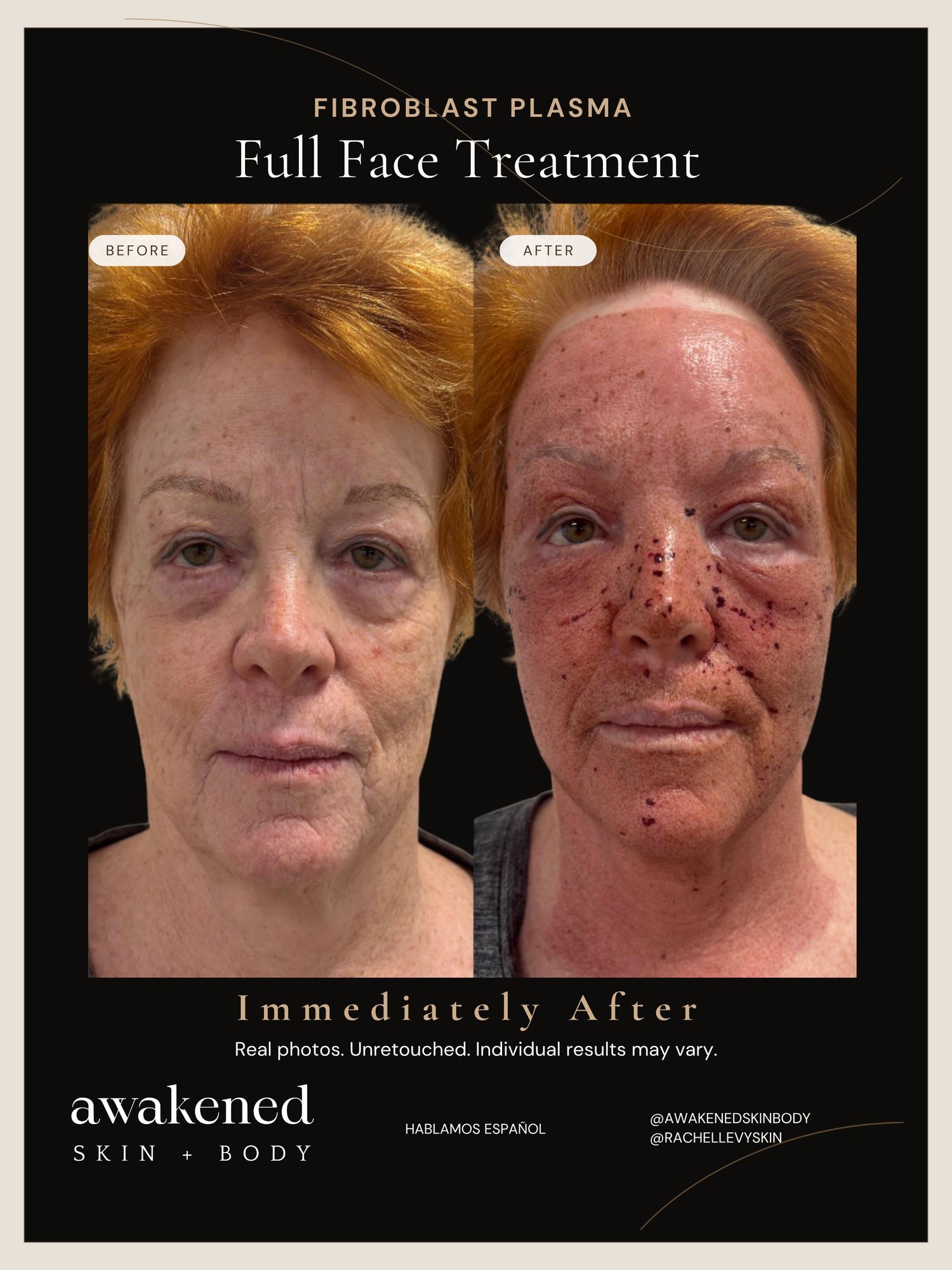 Full face Fibroblast result, before and after