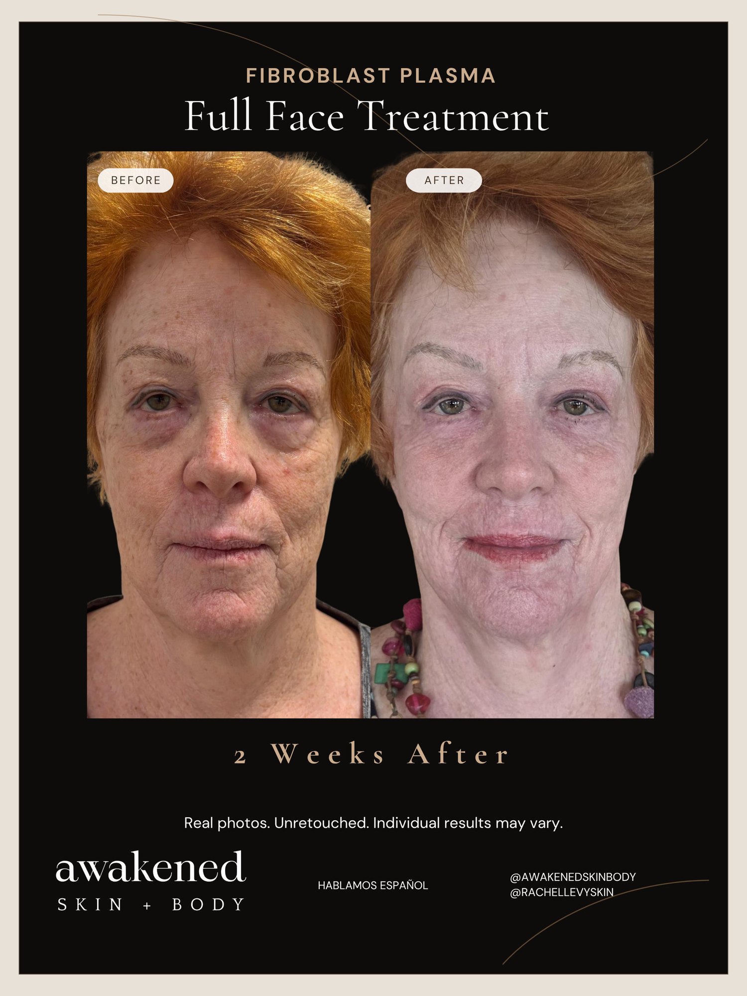 Full face Fibroblast result, before and after, two weeks after
