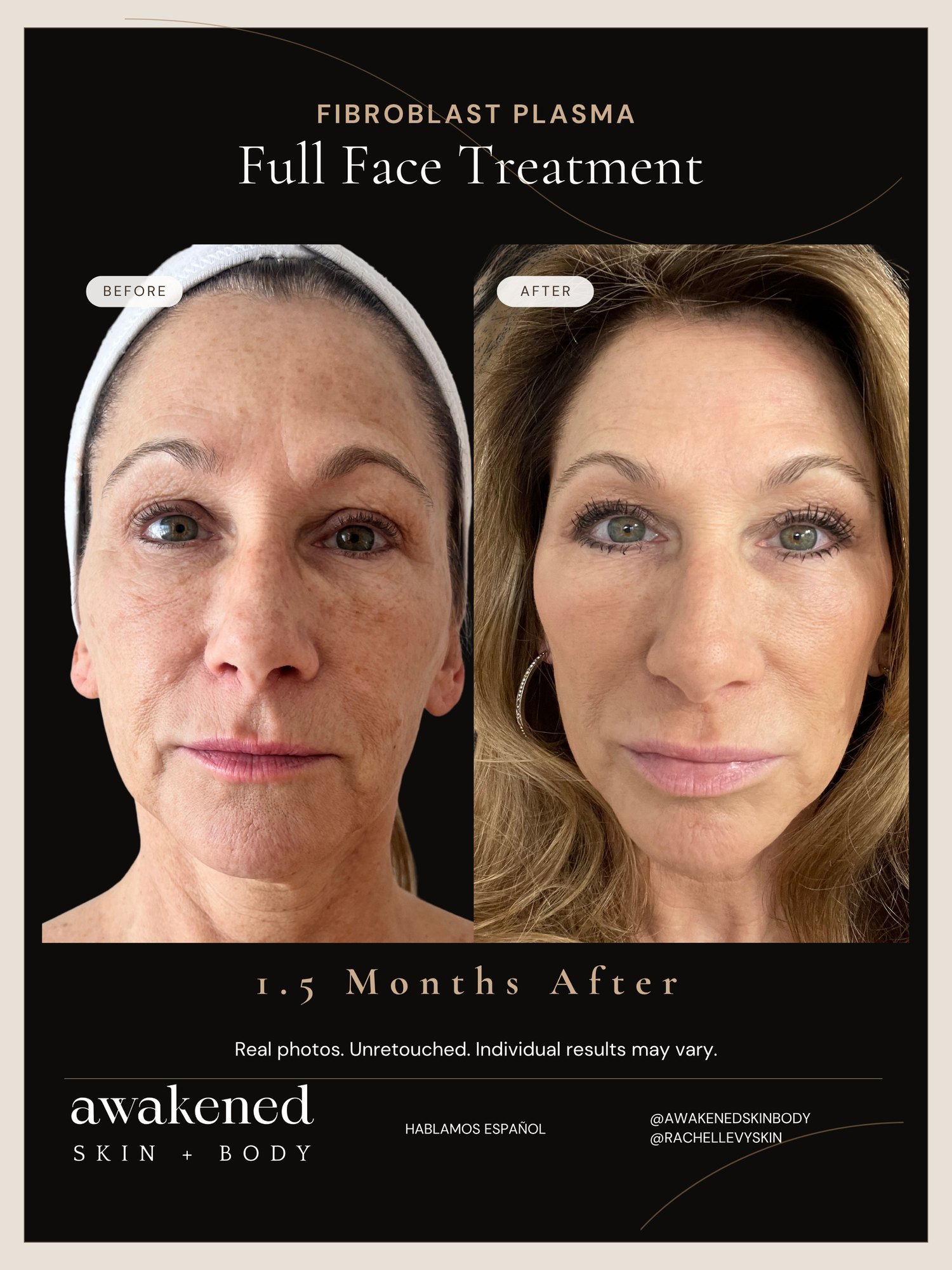 Fibroblast full face before and after, real client