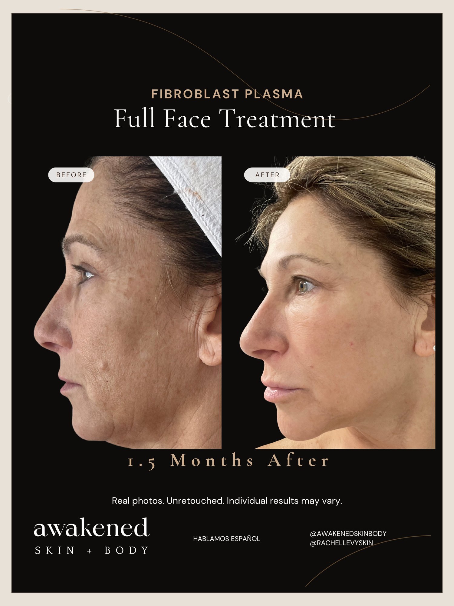 Full Face before and after, Fibroblast Plasma