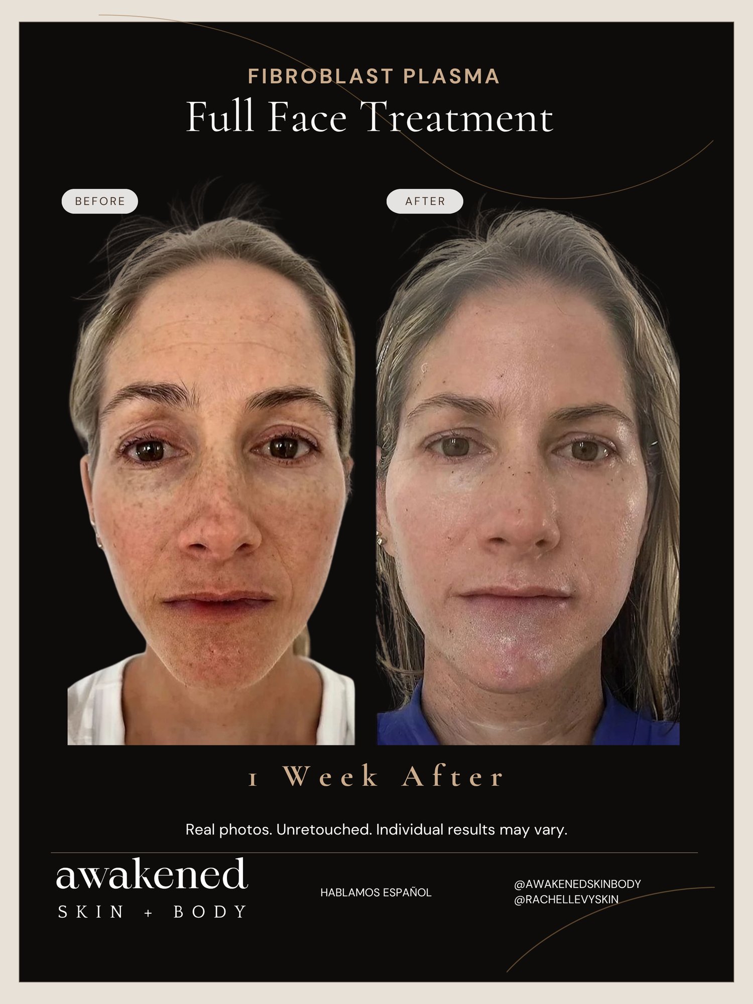 Full Face before and after, Fibroblast Plasma