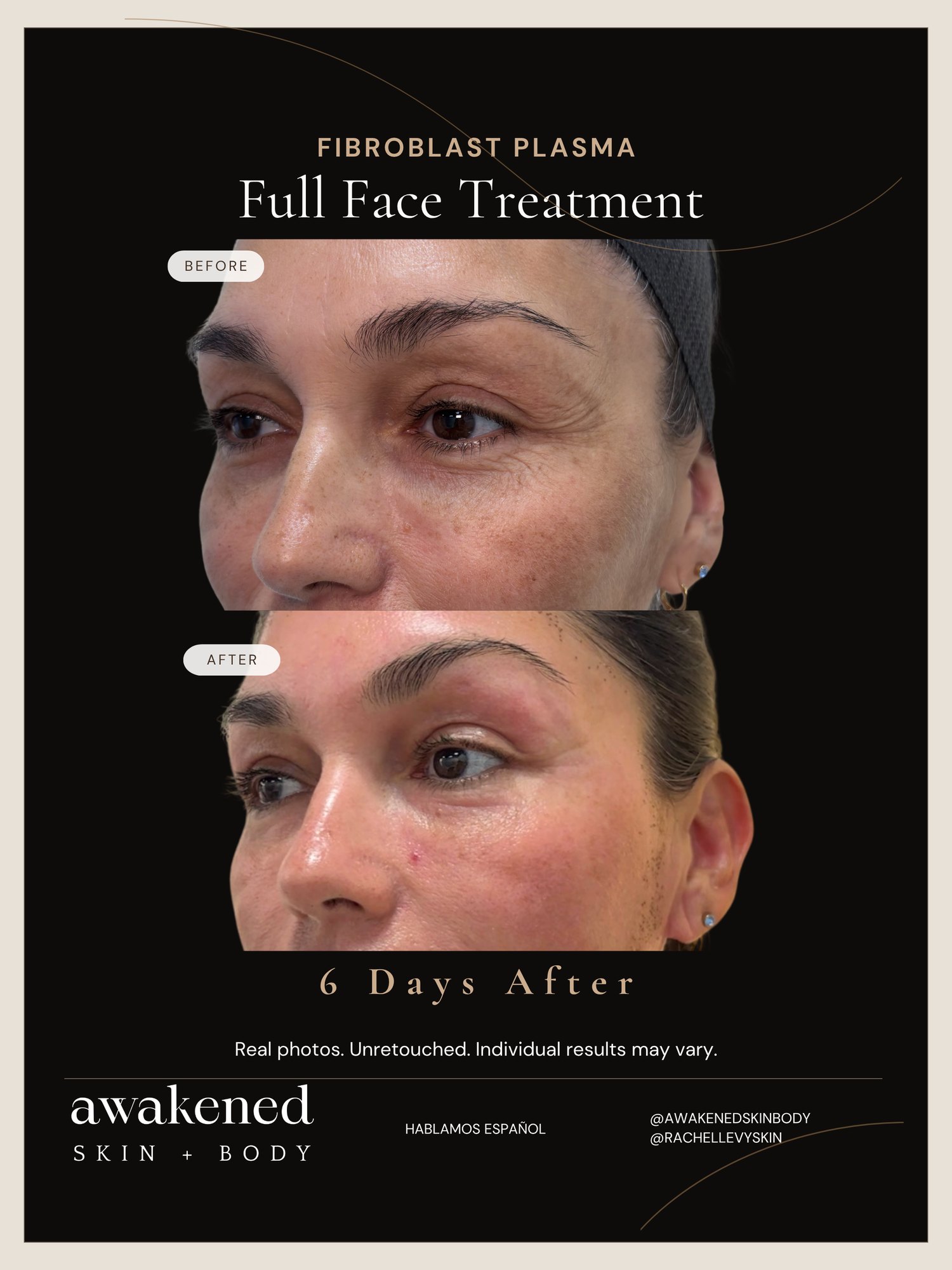 Fibroblast plasma full face before and after, Miami, real client