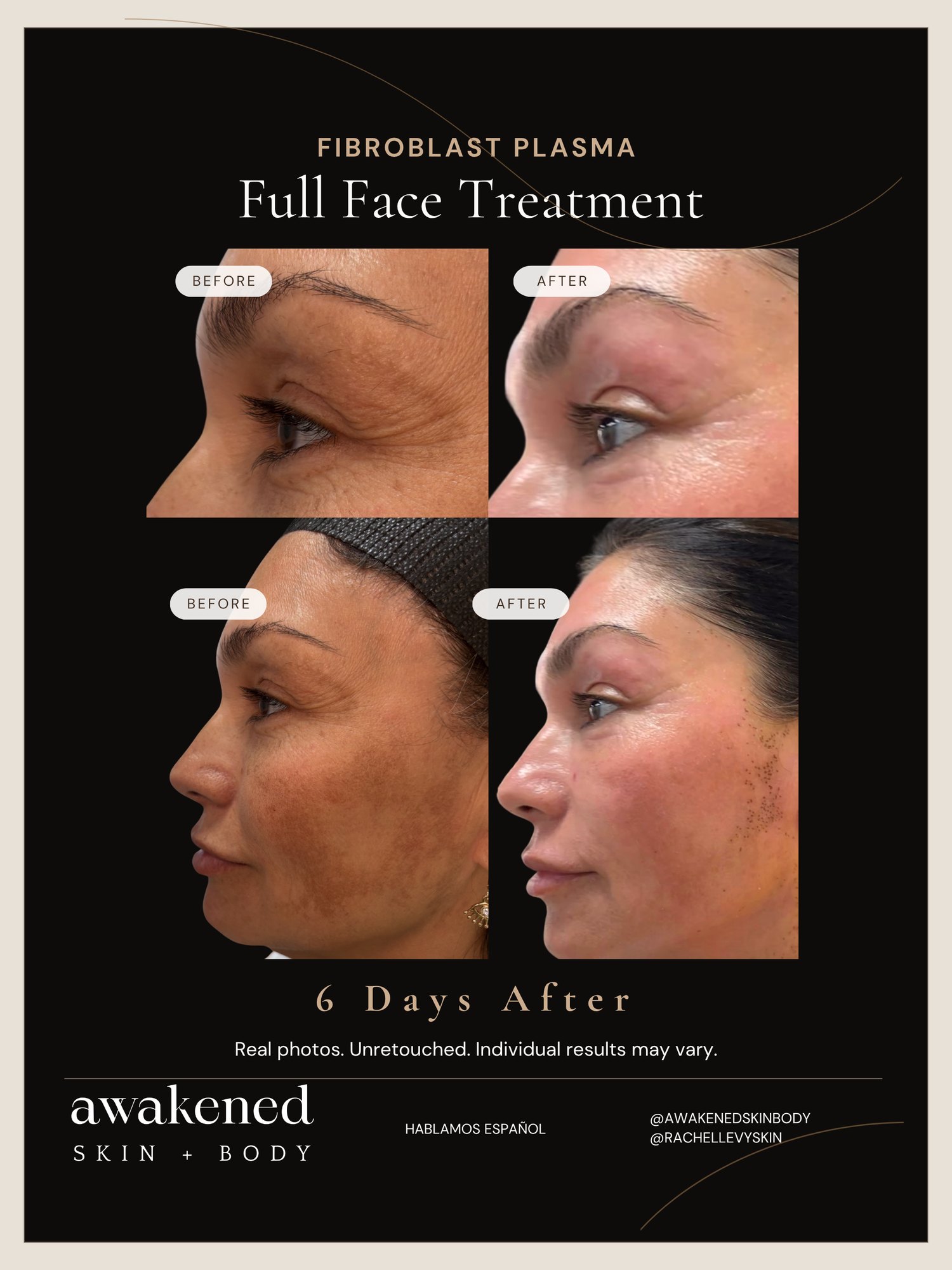 Full Face before and after, Fibroblast Plasma
