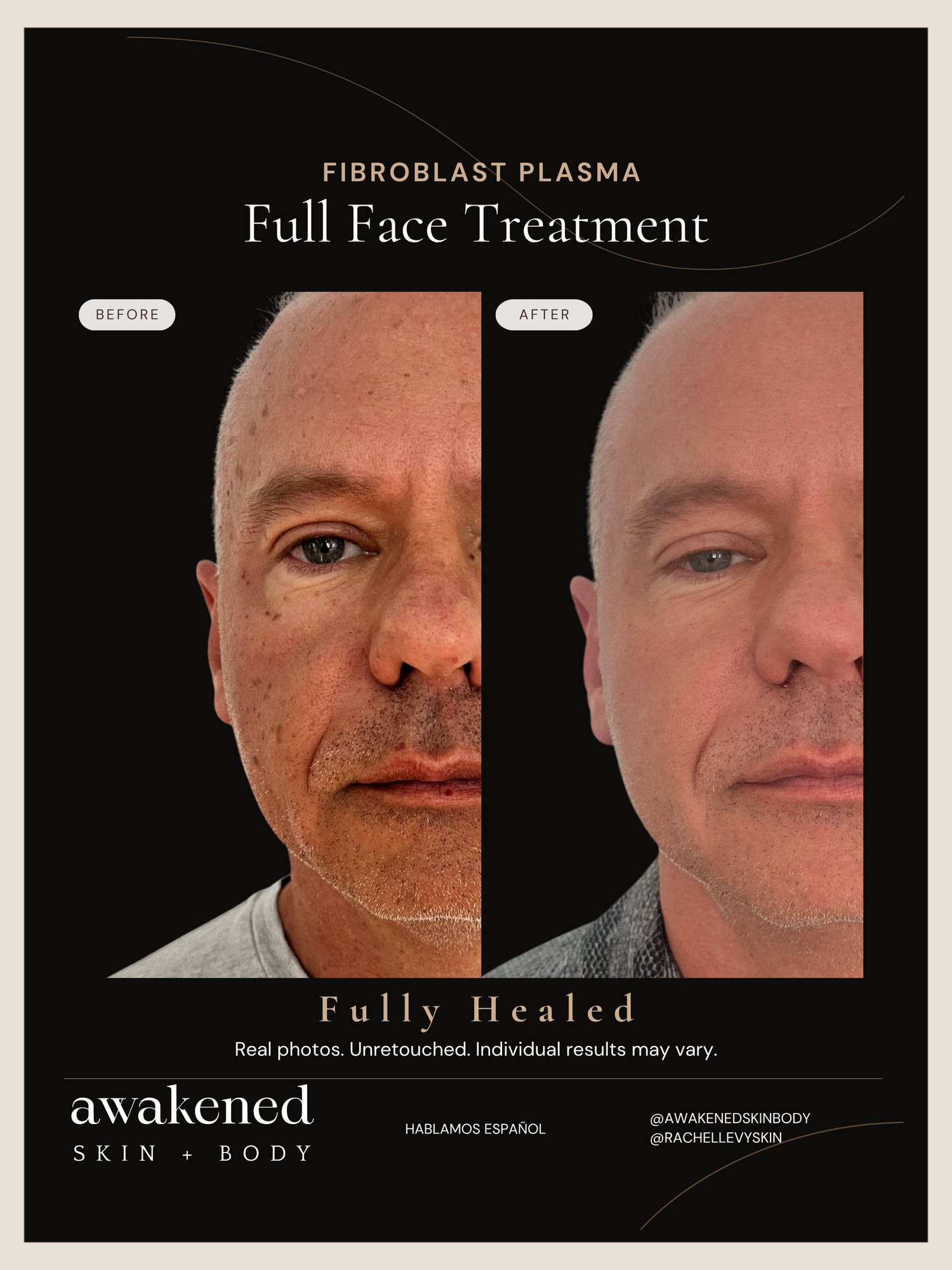 Full face Fibroblast result, before and after