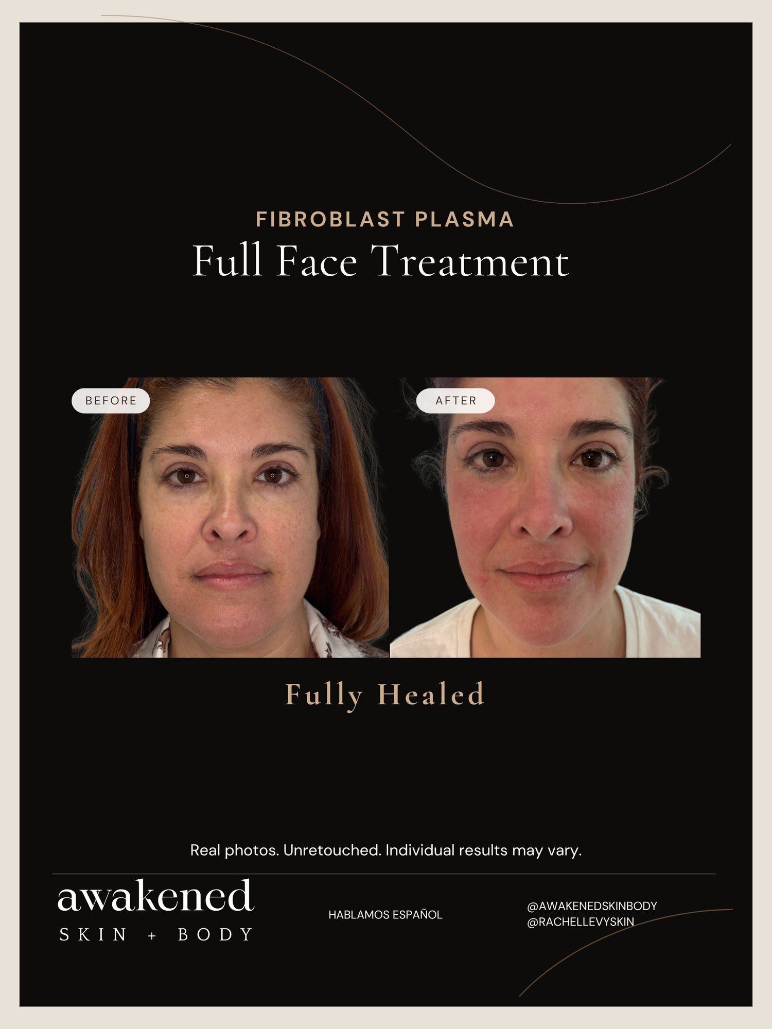 Full Face before and after, Fibroblast Plasma