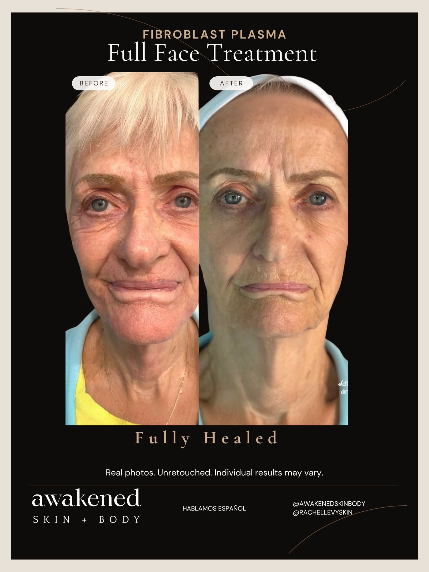 Full Face before and after, Fibroblast Plasma