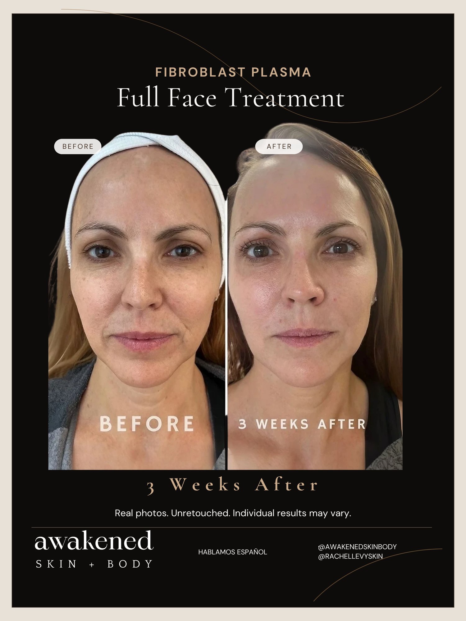 Full Face before and after, Fibroblast Plasma