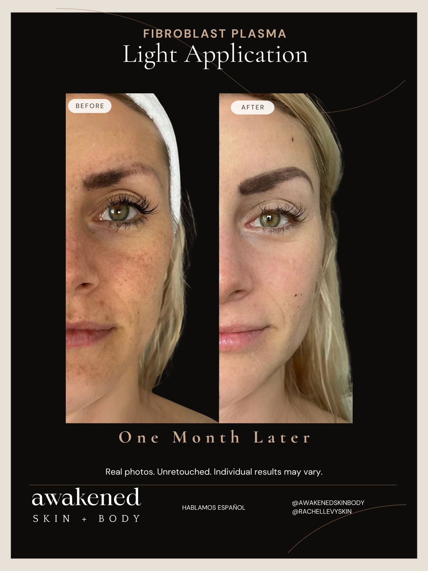 Full Face before and after, Fibroblast Plasma
