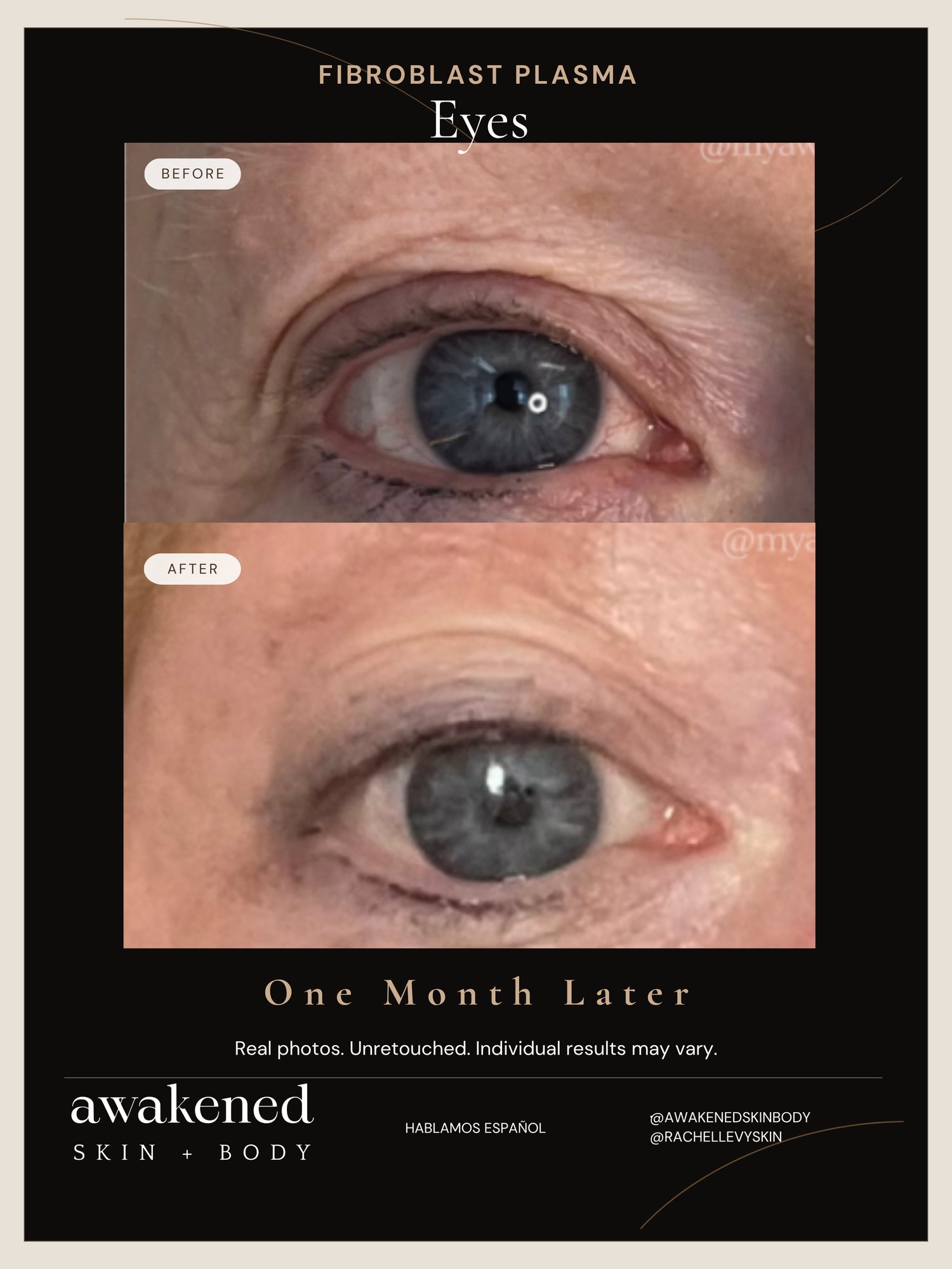 Full Face before and after, Fibroblast Plasma
