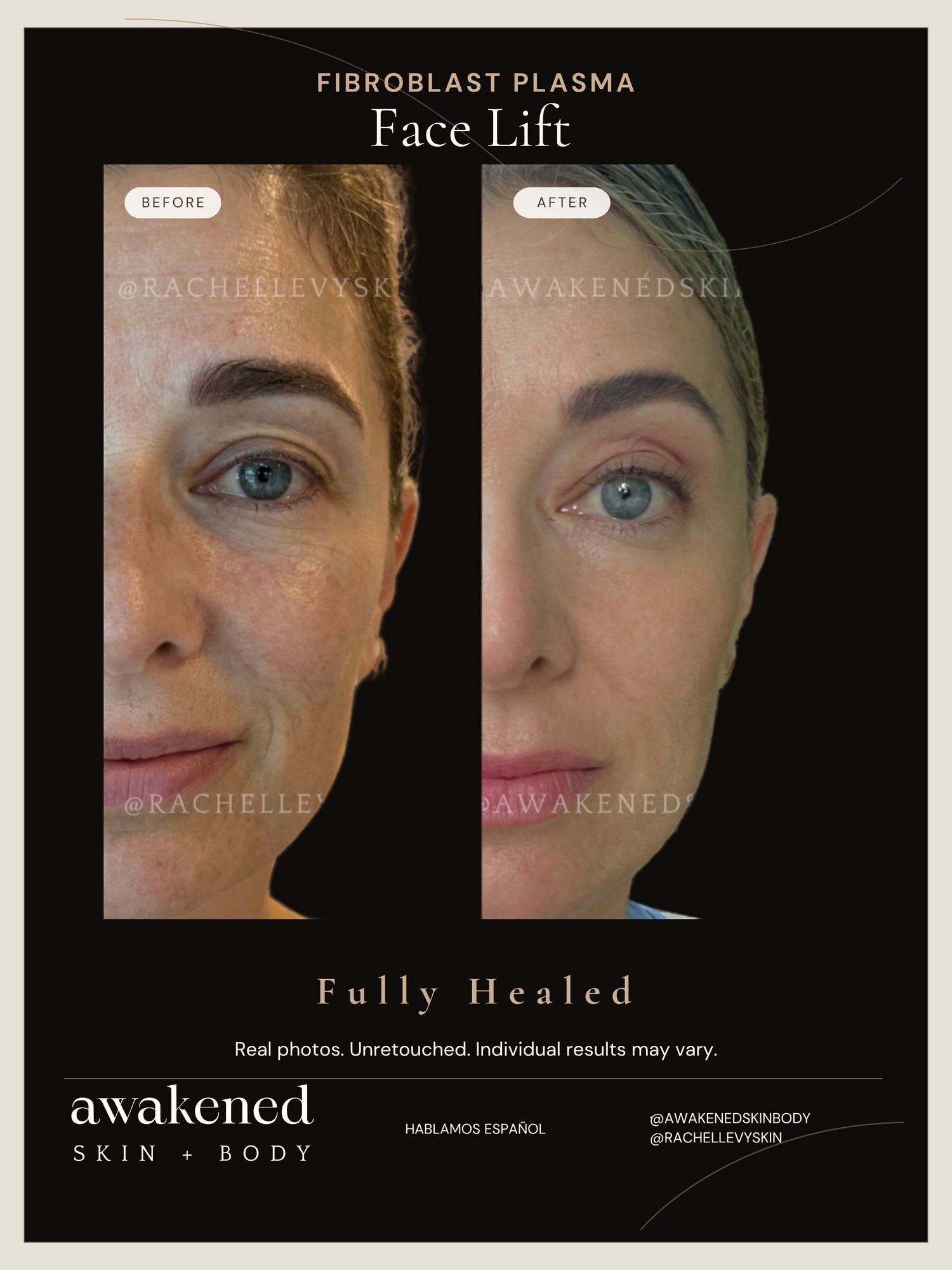 Full Face before and after, Fibroblast Plasma
