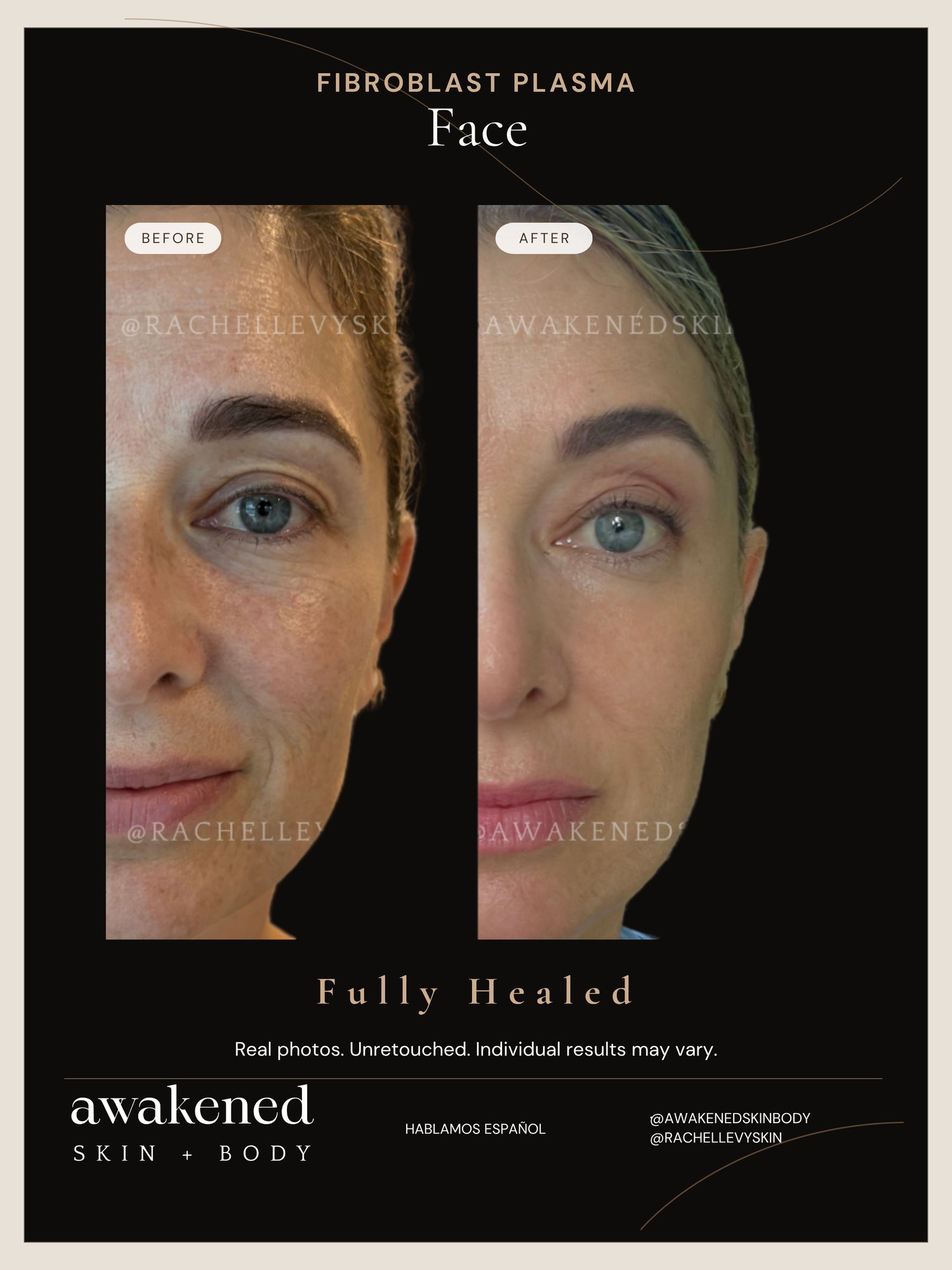 Full Face before and after, Fibroblast Plasma