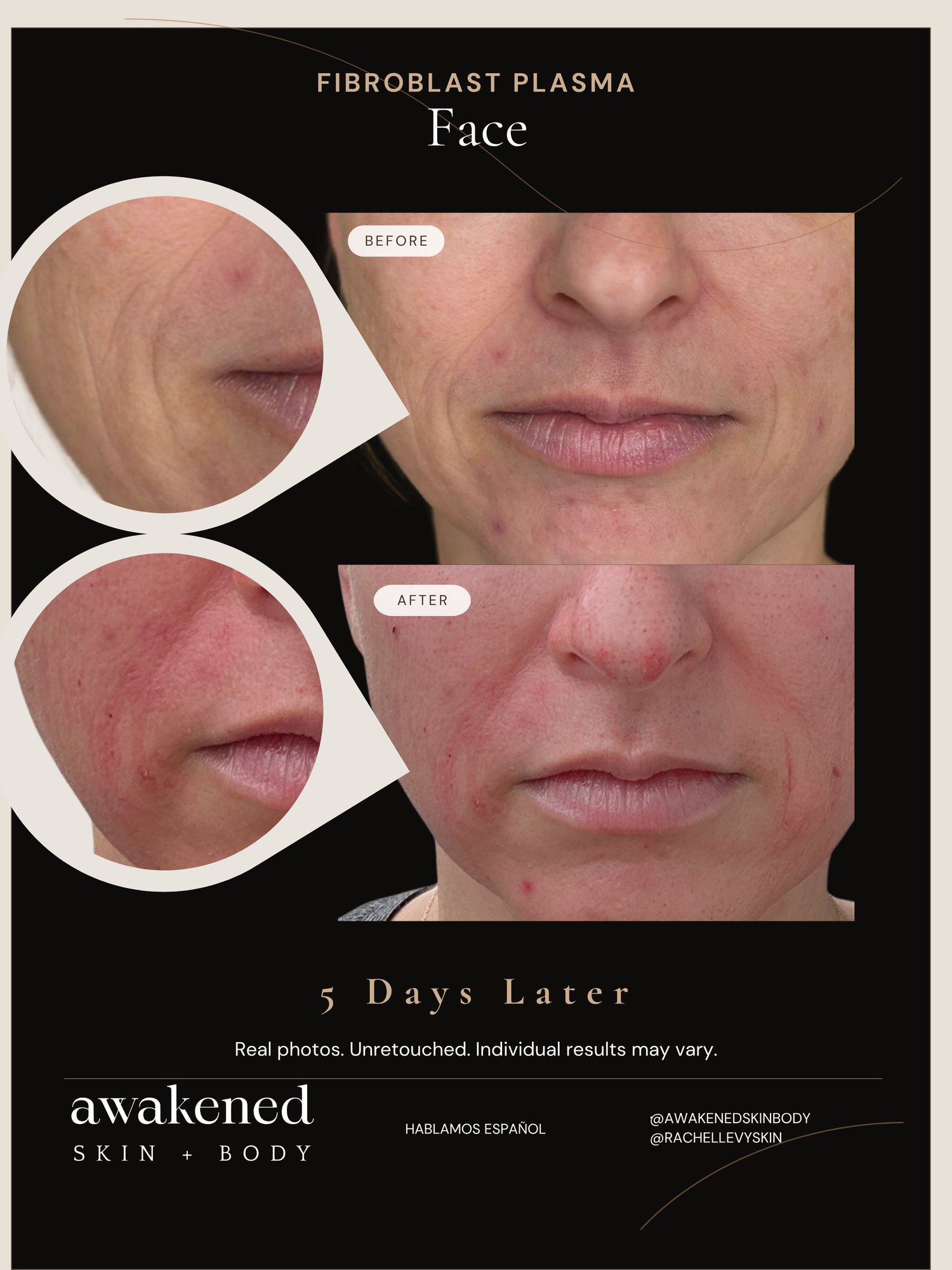 Full Face before and after, Fibroblast Plasma