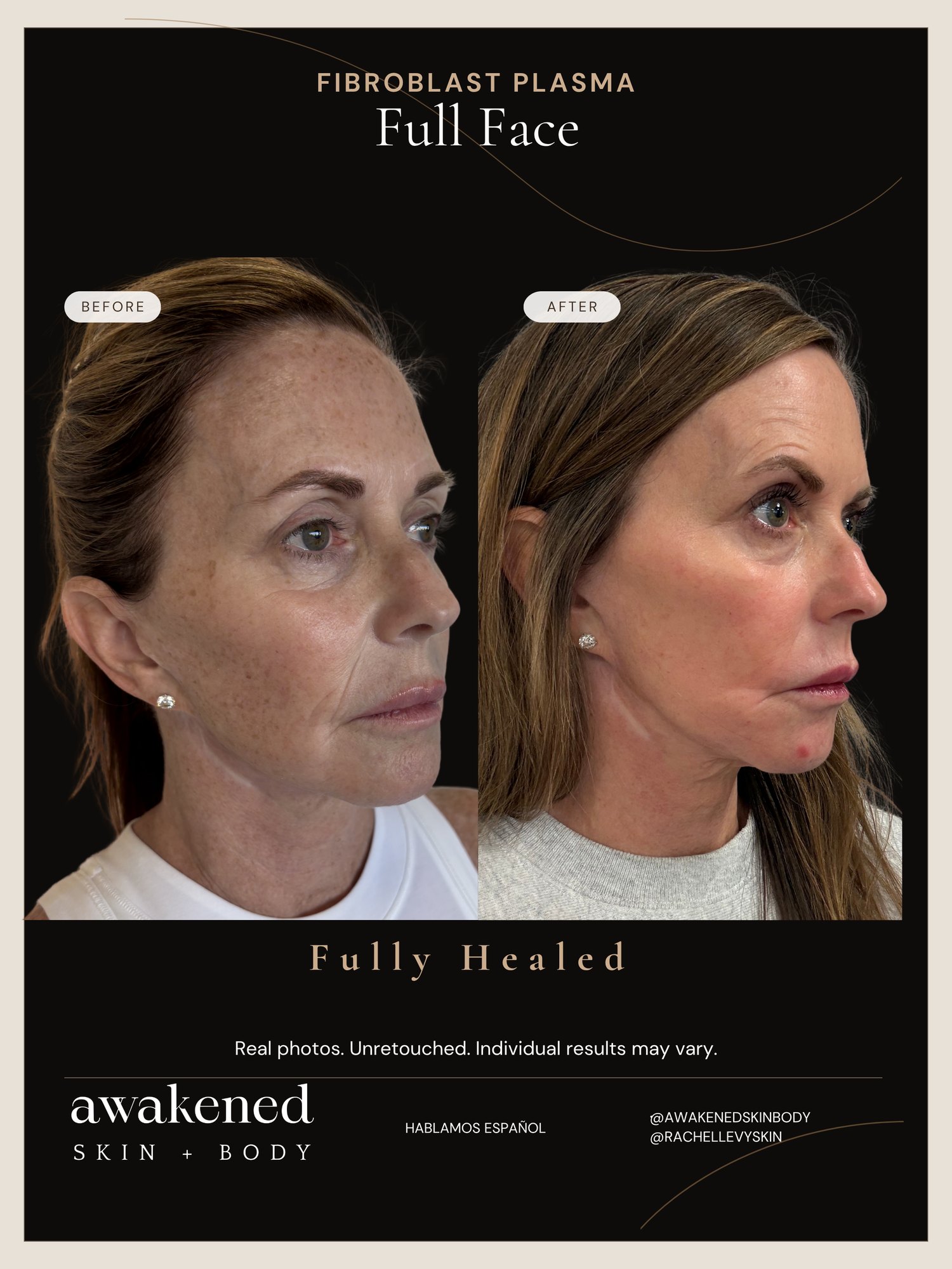 Full Face before and after, Fibroblast Plasma