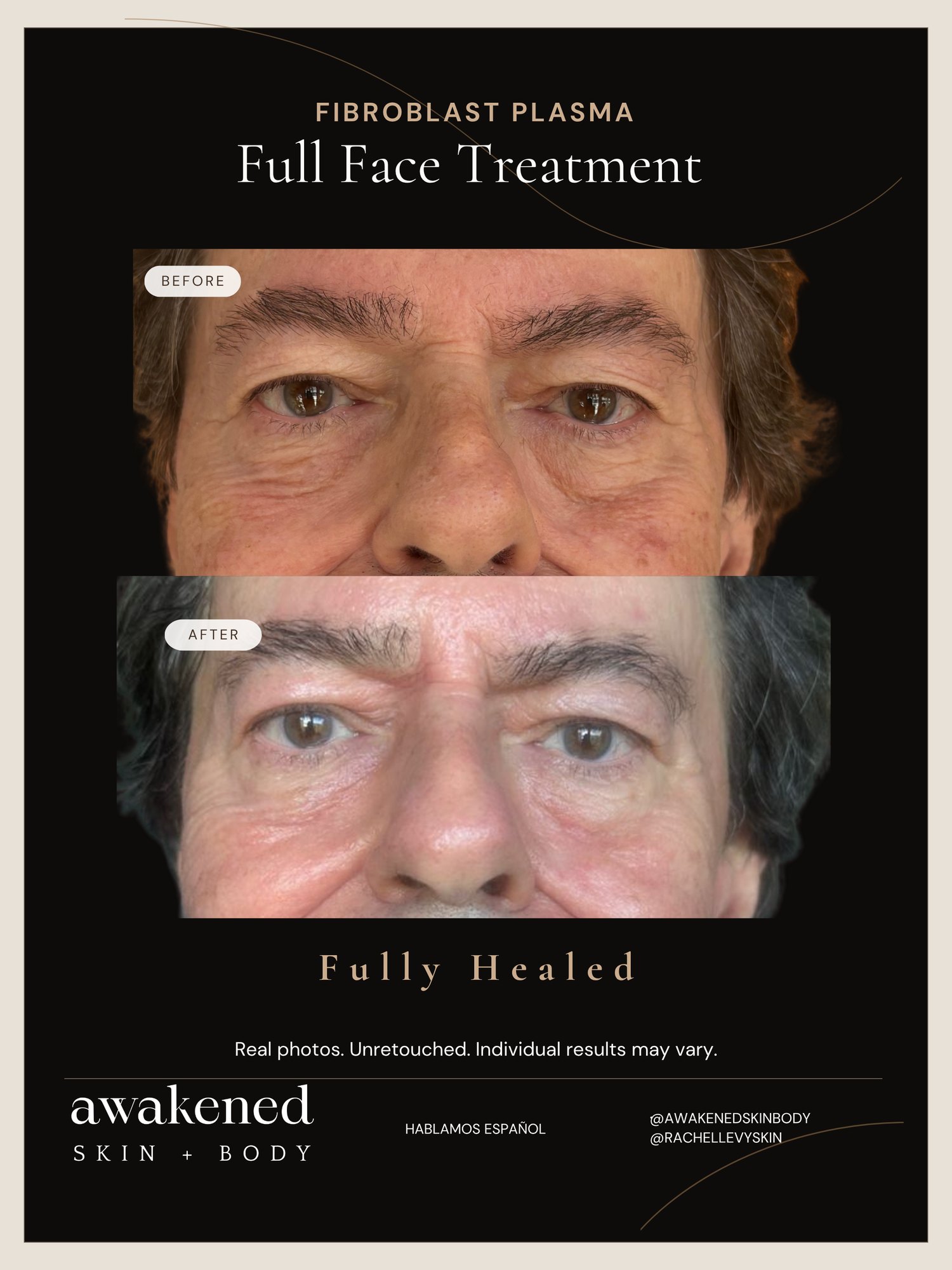 Full Face before and after, Fibroblast Plasma