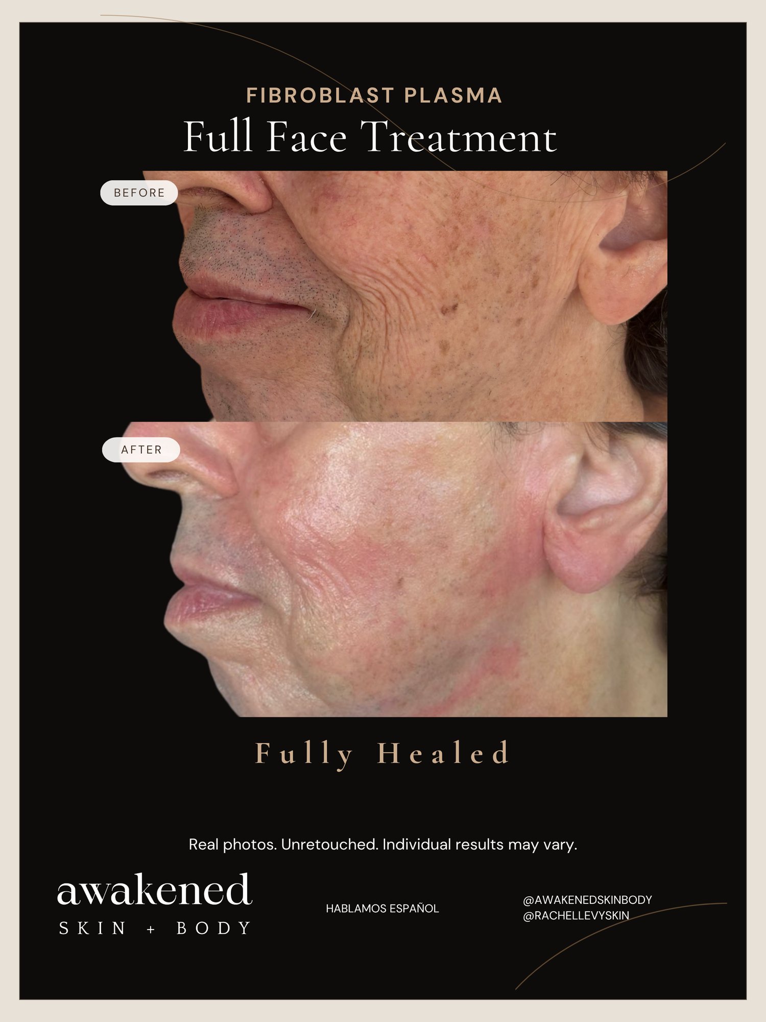 Full Face before and after, Fibroblast Plasma
