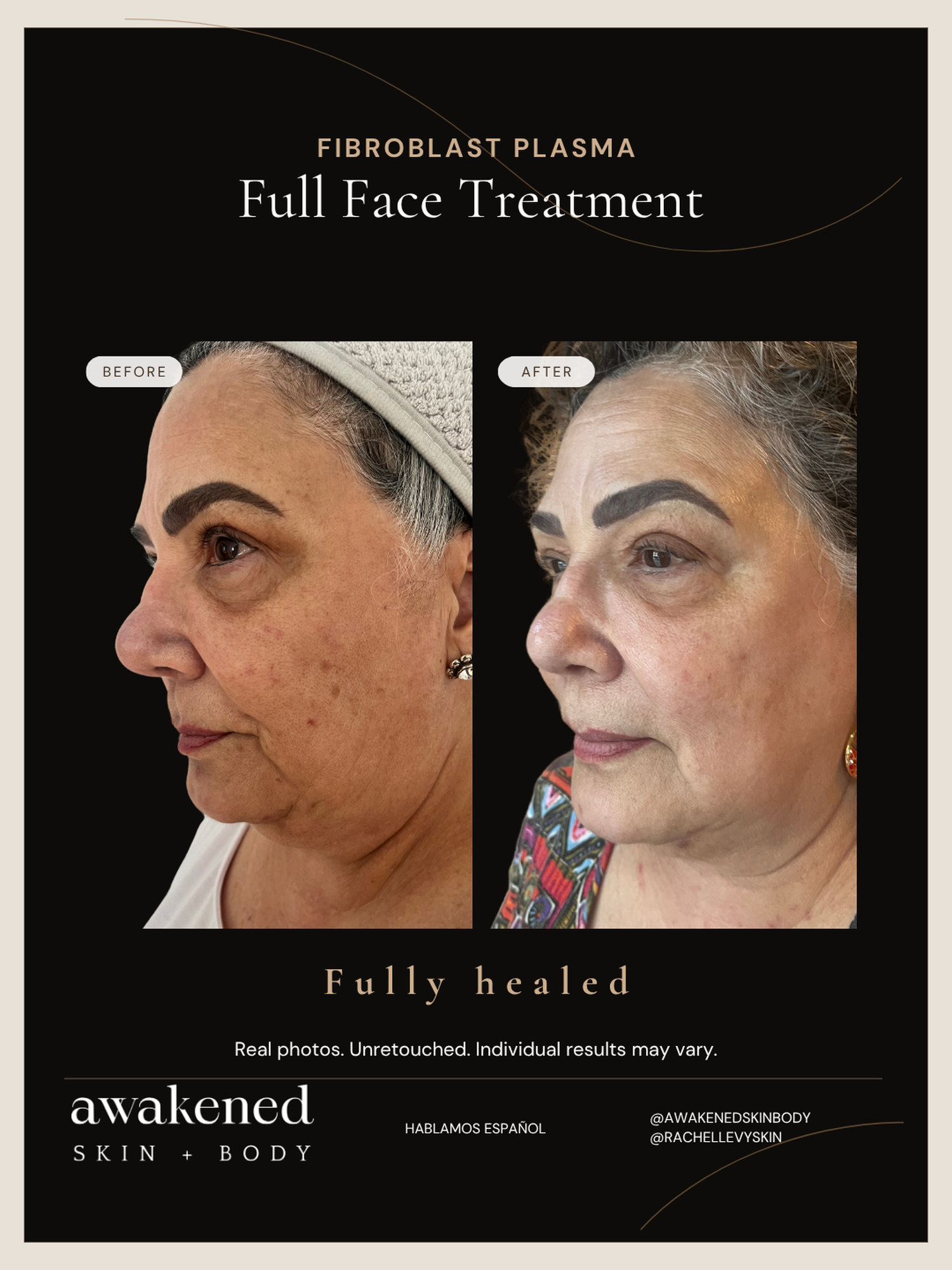Full face before and after, Fibroblast Plasma
