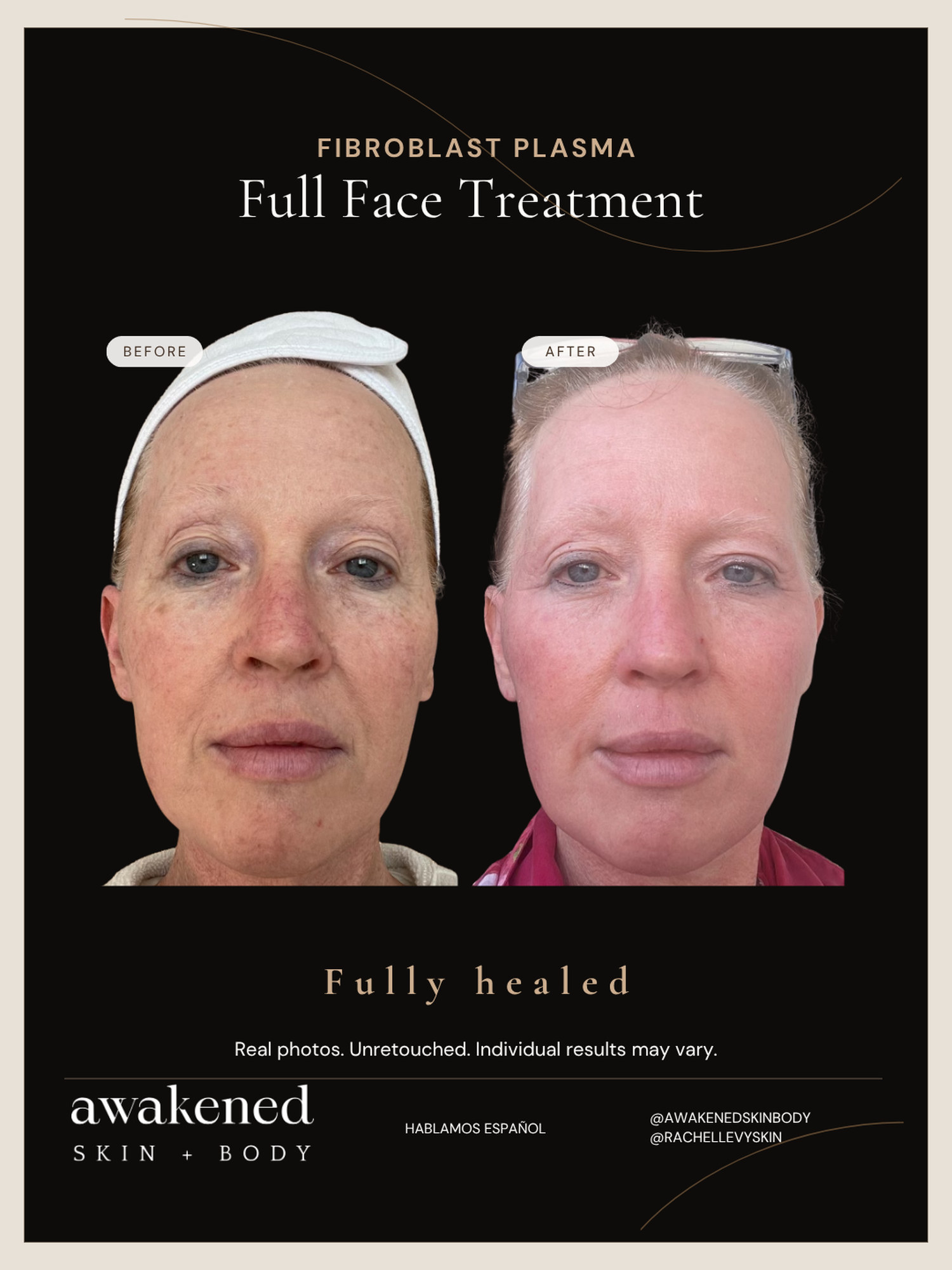 Full face before and after, Fibroblast Plasma