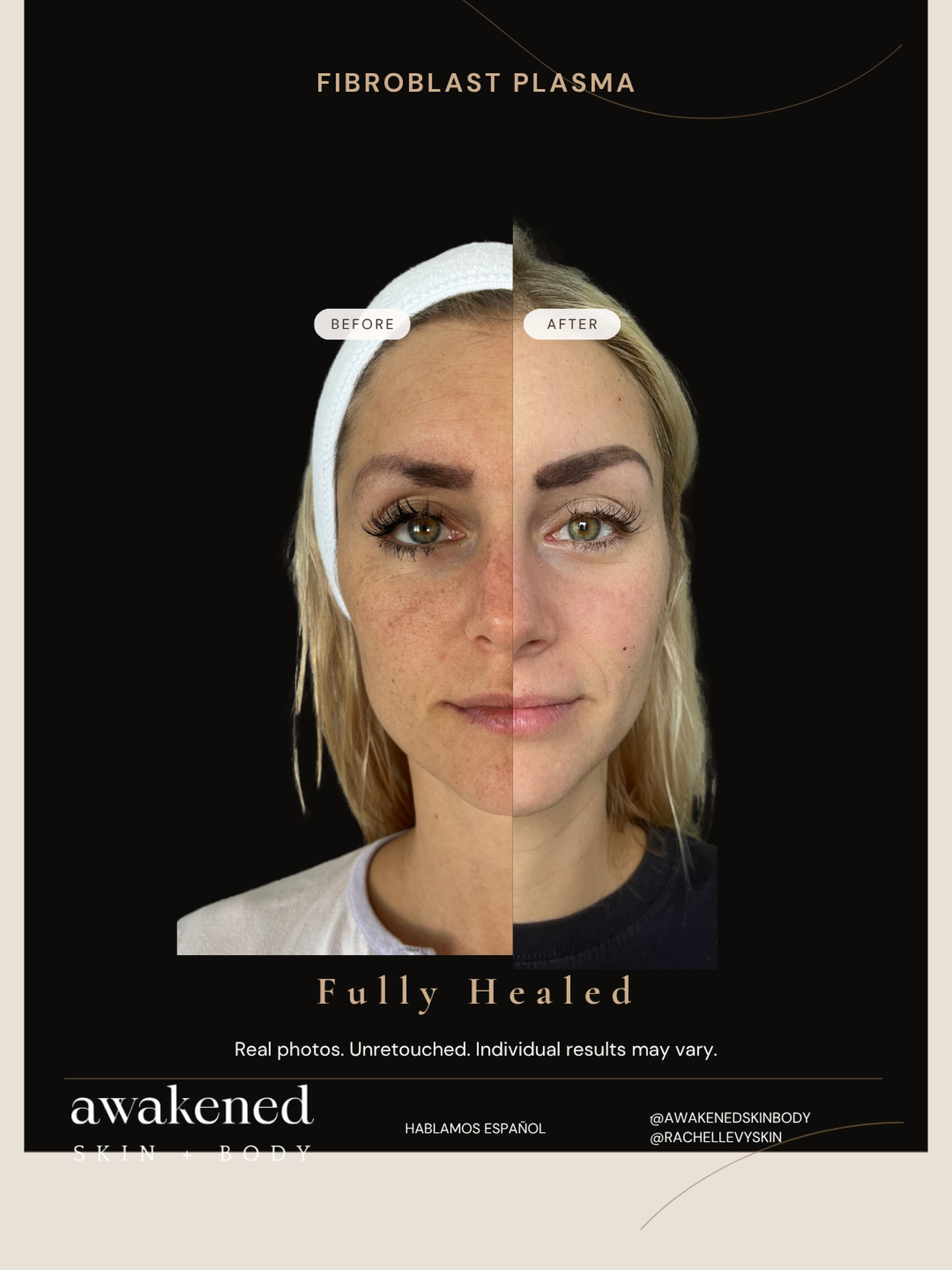 Full face before and after, Fibroblast Plasma