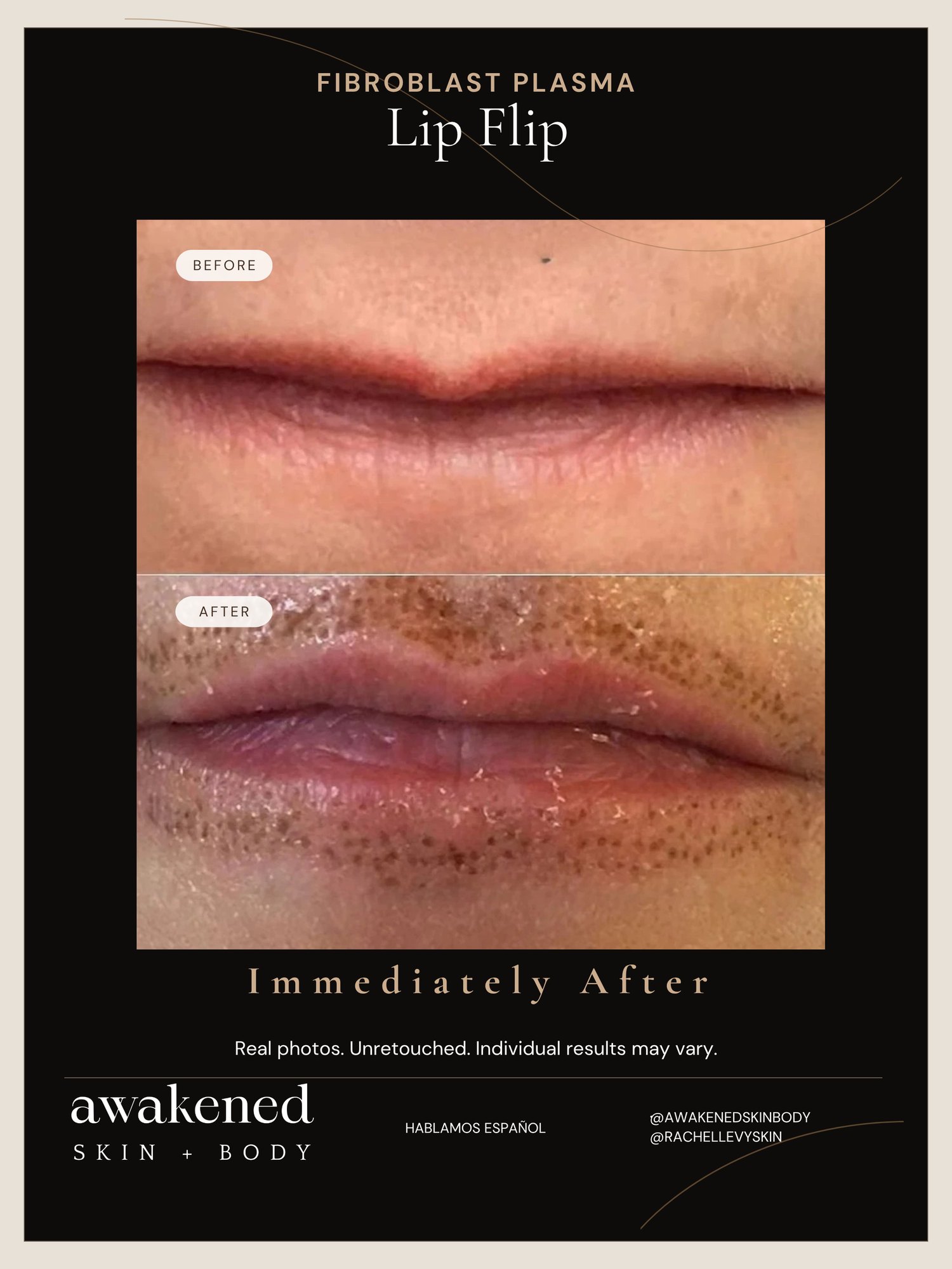 Lip Lift before and after, Fibroblast Plasma