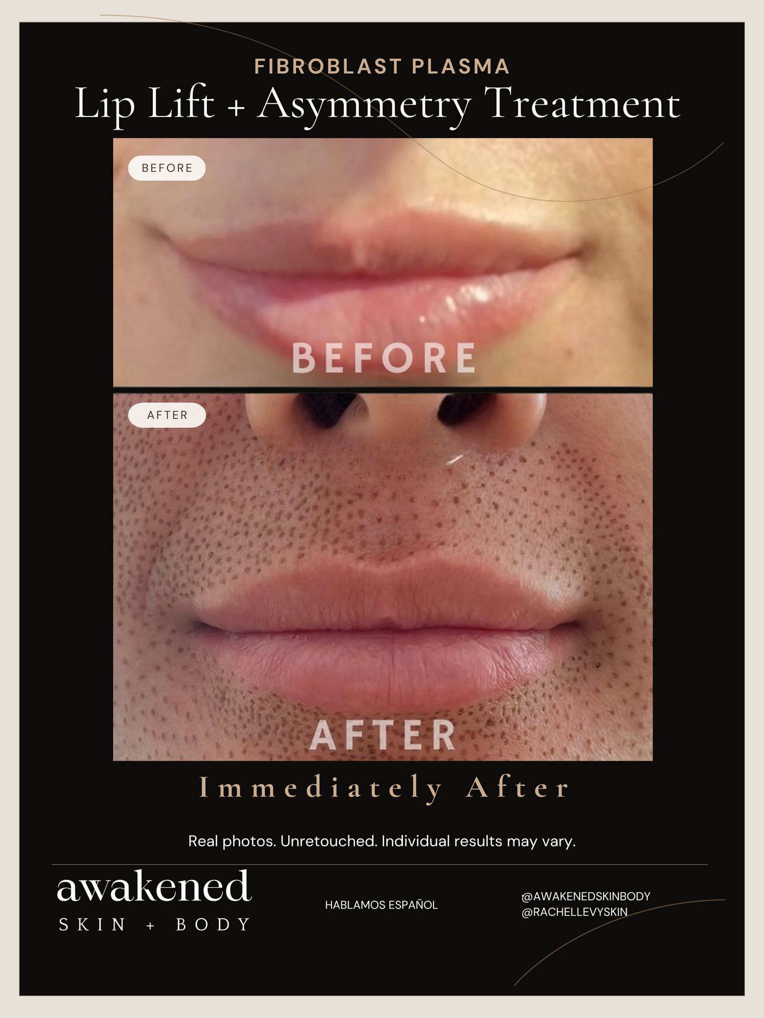 Lip Lift before and after, Fibroblast Plasma